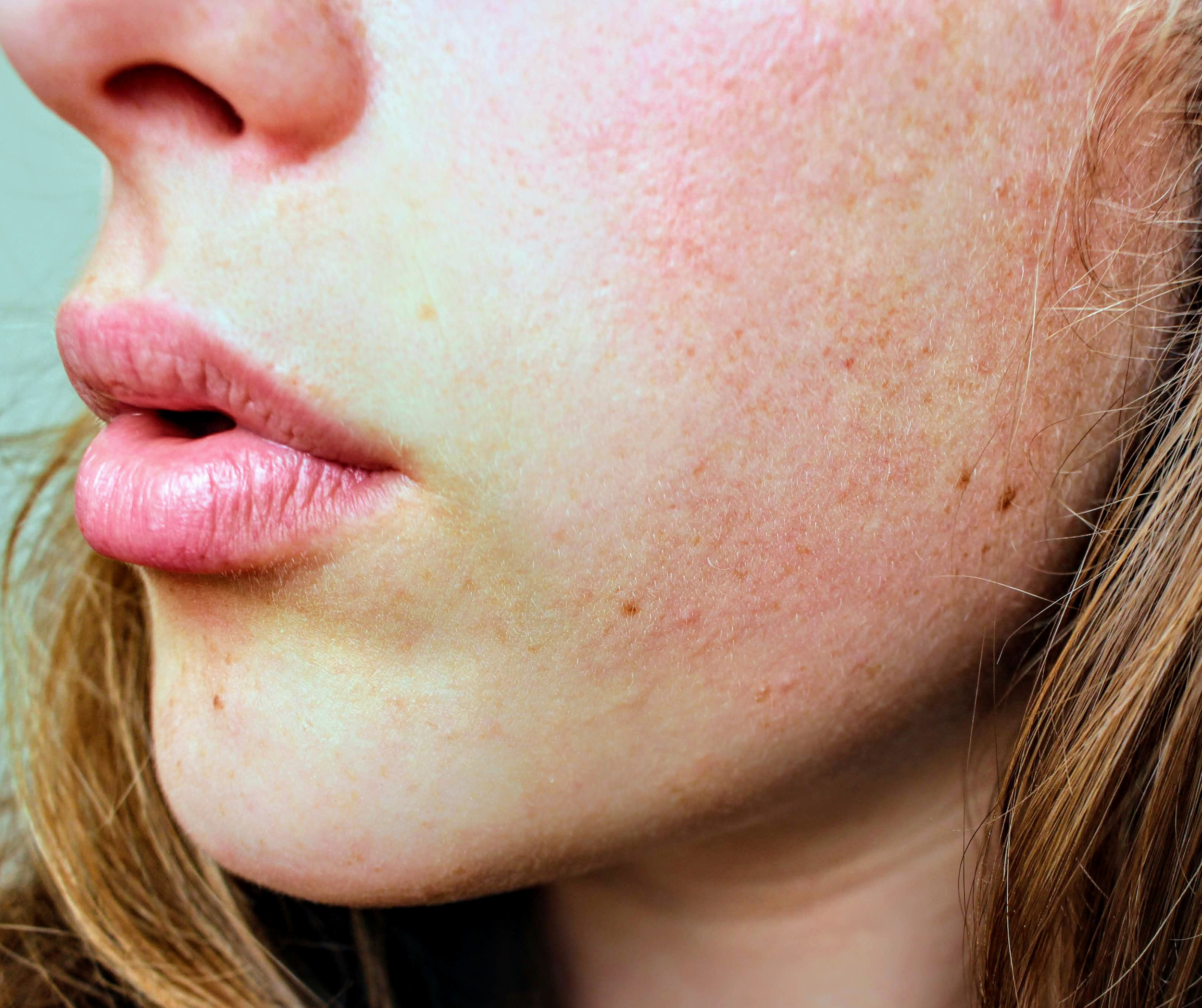Why Your Skin Feels So Dry in Winter (and What Actually Helps)