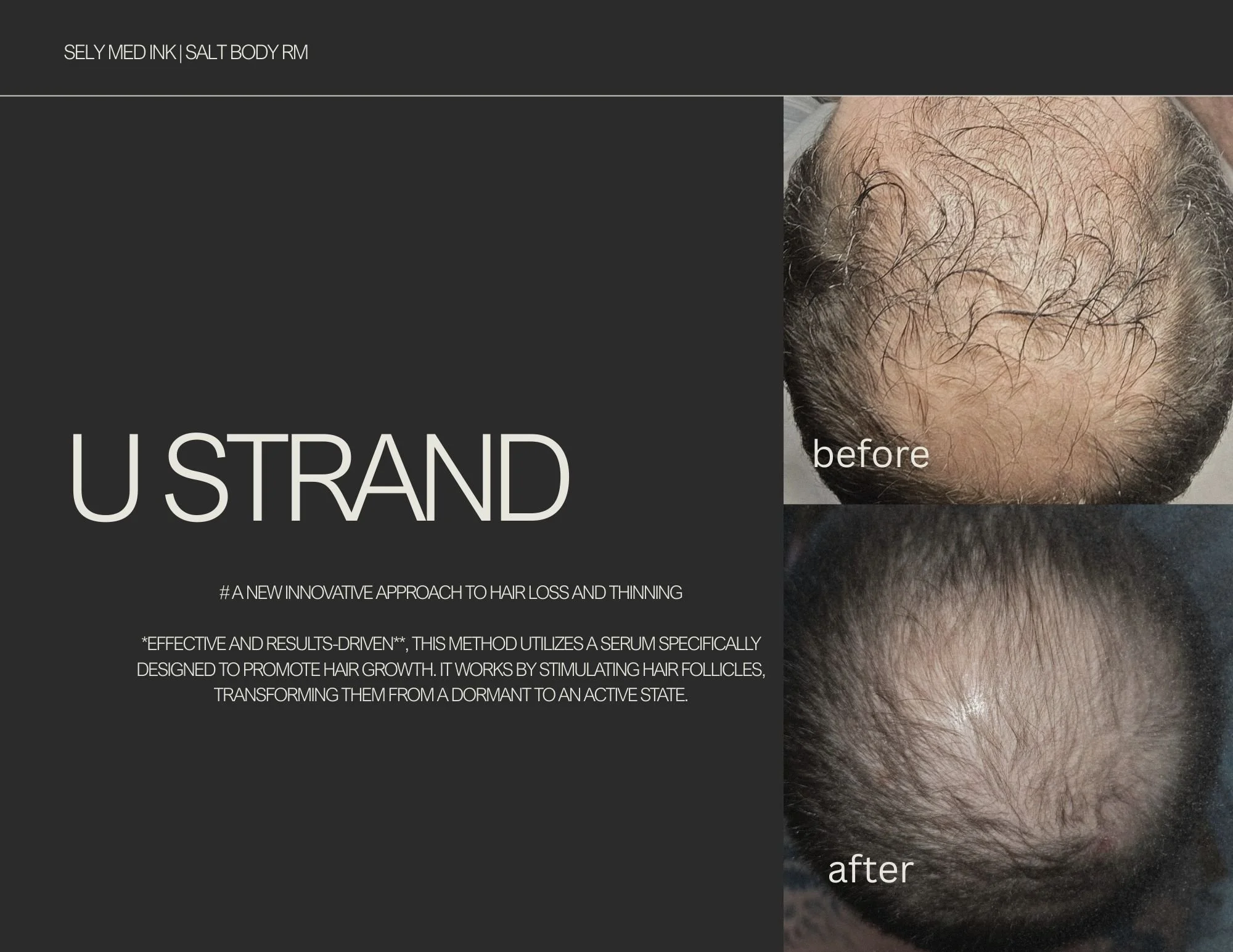 UStrand* Hair Loss Treatment (Copy)