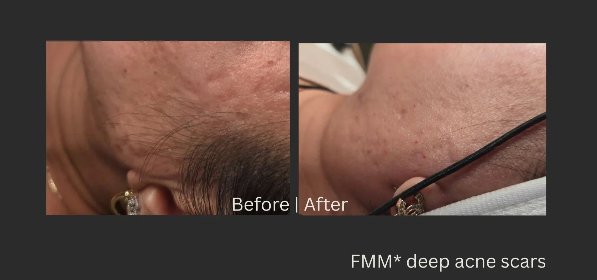 Focused Medical Micro-Needling *FMM 