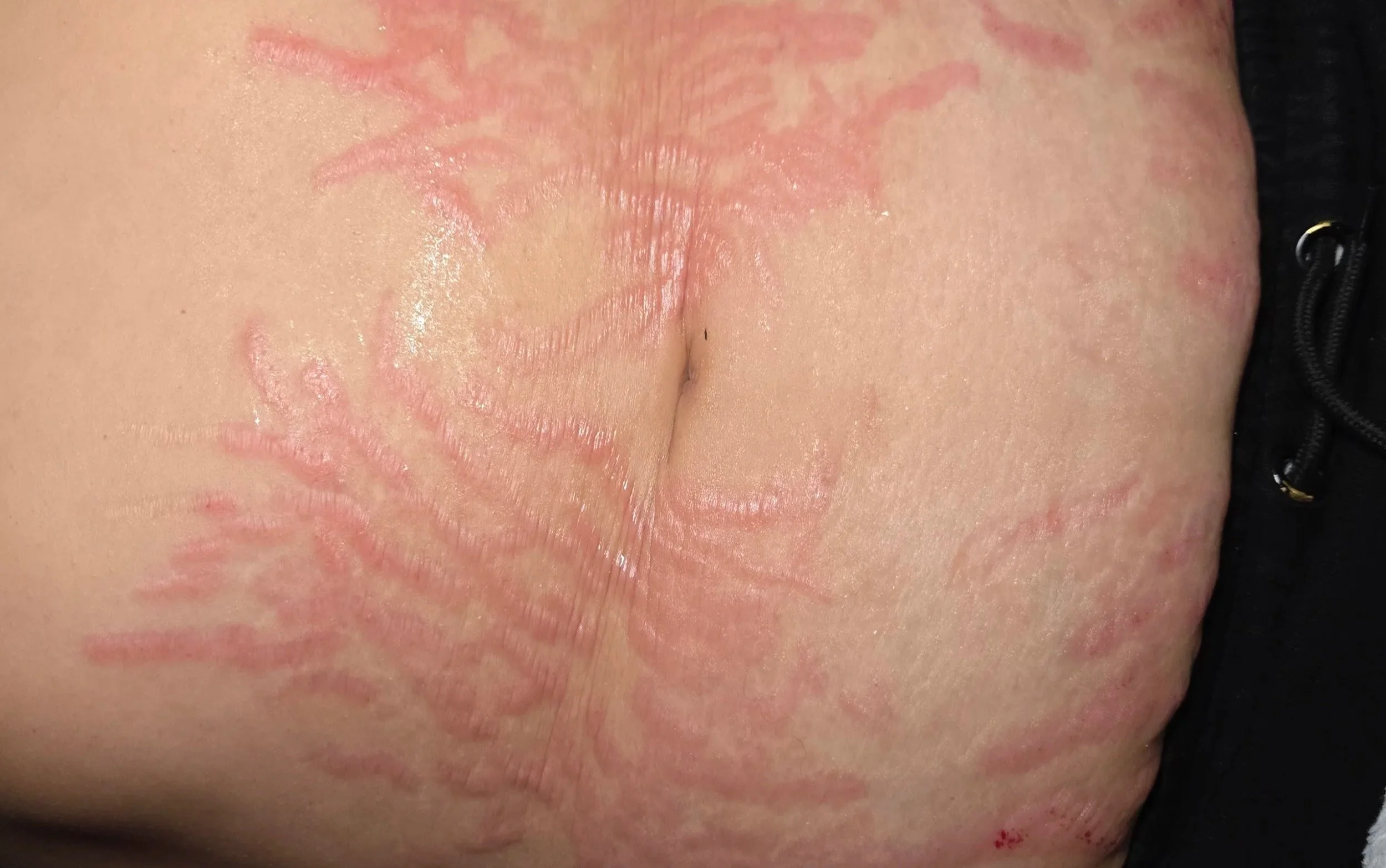 Inkless Scar and Stretchmark Rejuvenation 