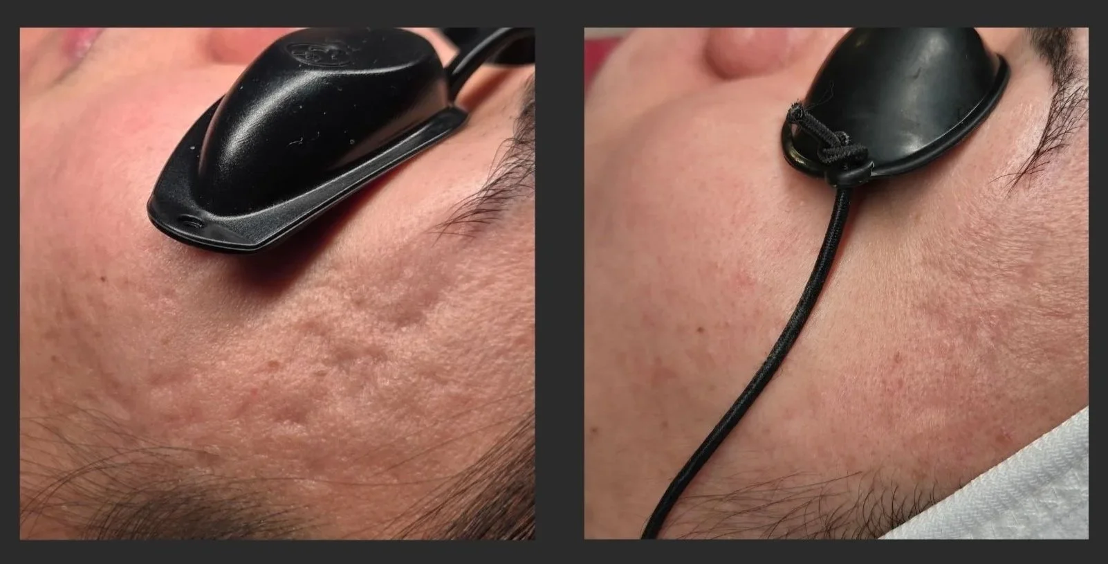 Acne Scar Treatment A.S.E. Acne Scar Eraser