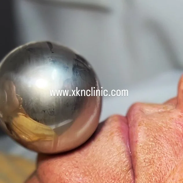 Close-up of a person's tongue with a metallic ball placed on it, with the website 'www.xknclinic.com' overlaid on the image.