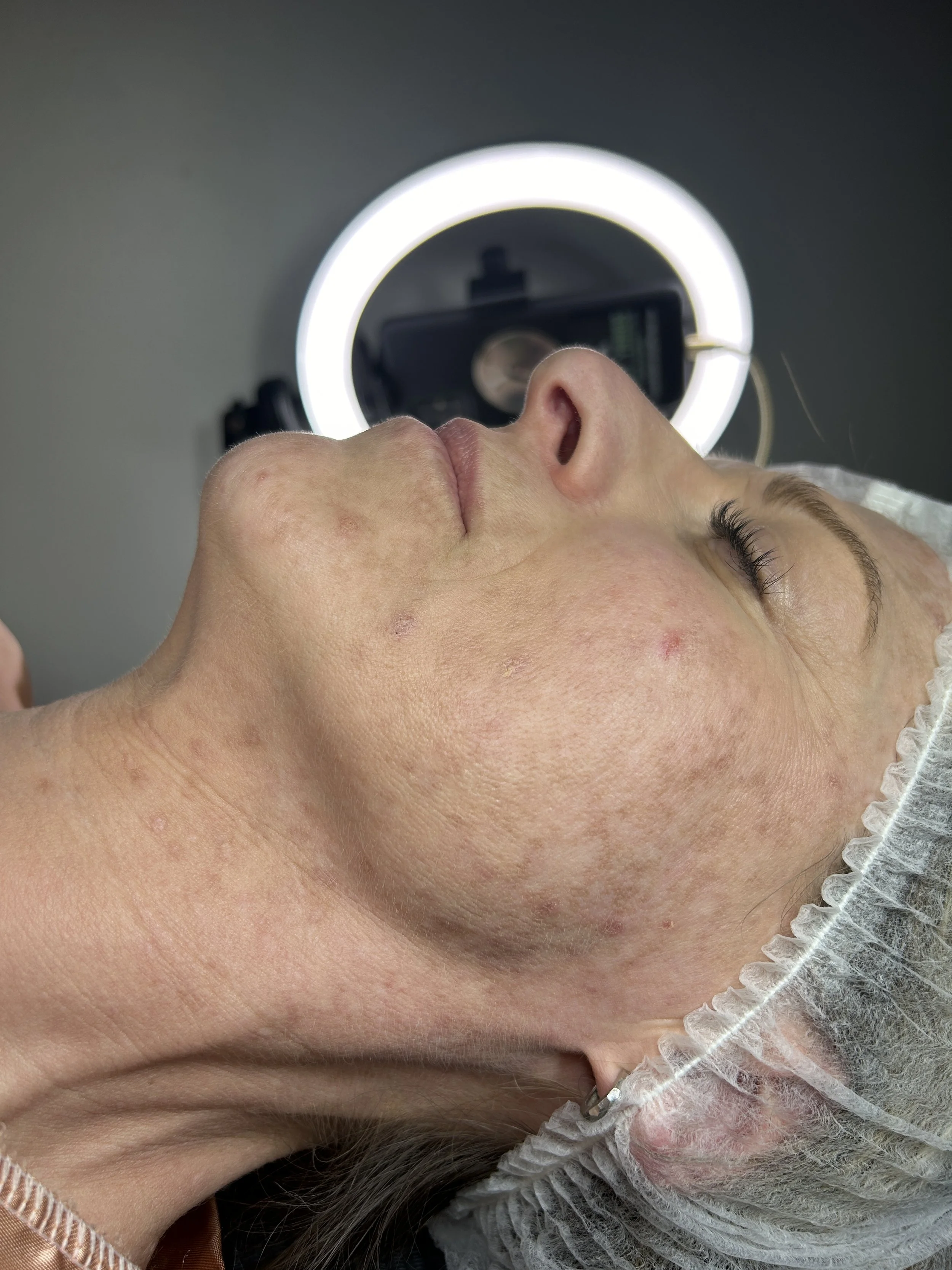 Close-up of a woman lying on a treatment table with her eyes closed, receiving a facial or skin treatment, with a circular light device above her face.