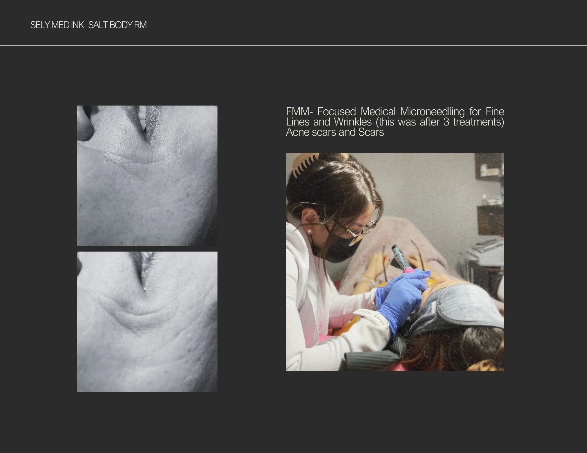 FMM* Focused Medical Microneedling