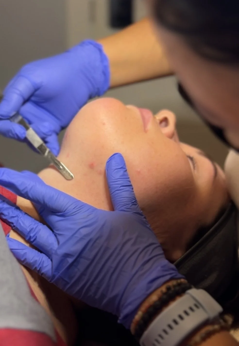 Close-up of a person receiving a facial treatment or skin care procedure, with a healthcare professional wearing blue gloves using a tool on their chin and jawline.