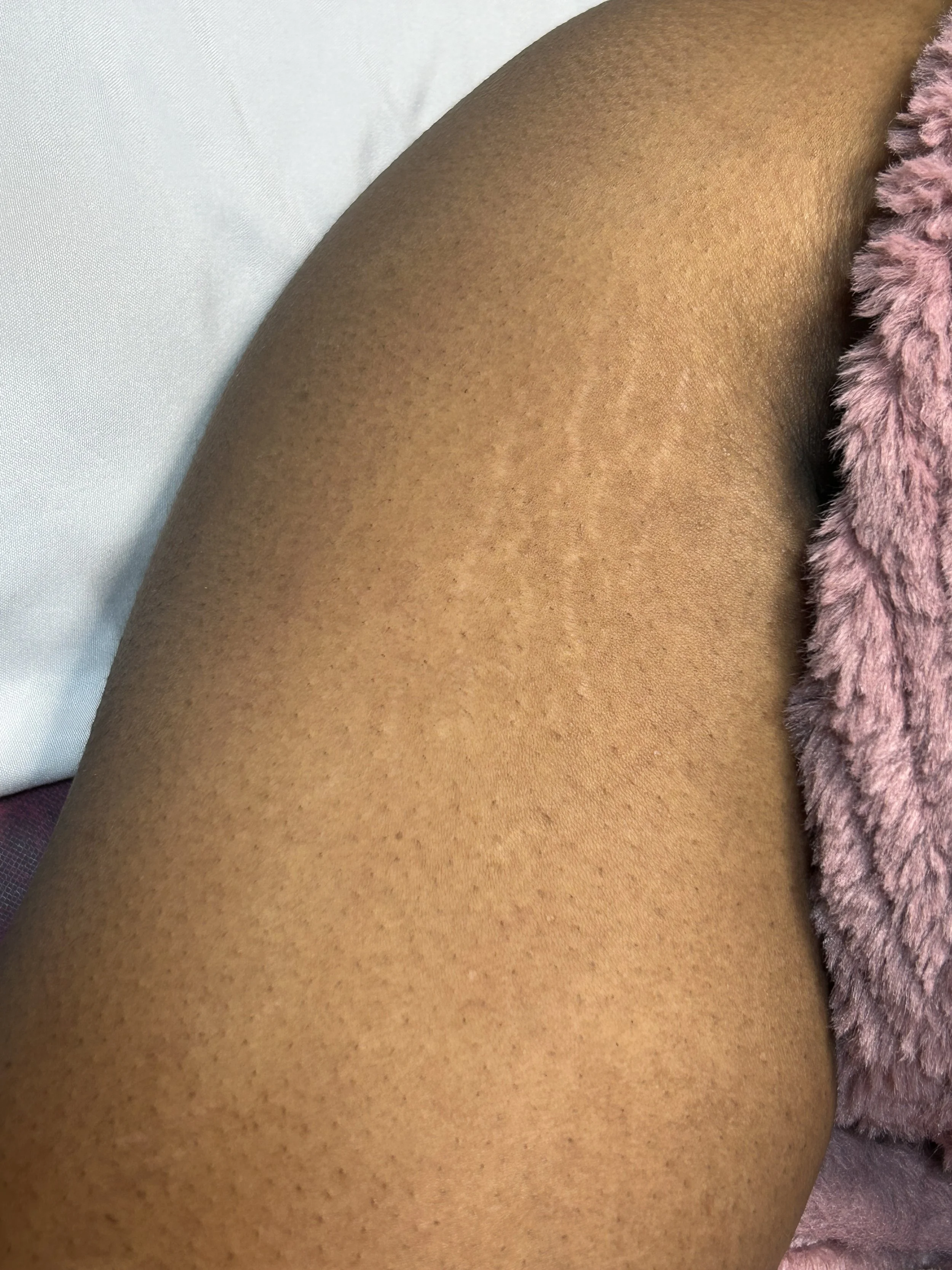 Close-up of a person's thigh with hyperpigmentation and freckles, partially covered by a pink fluffy fabric.