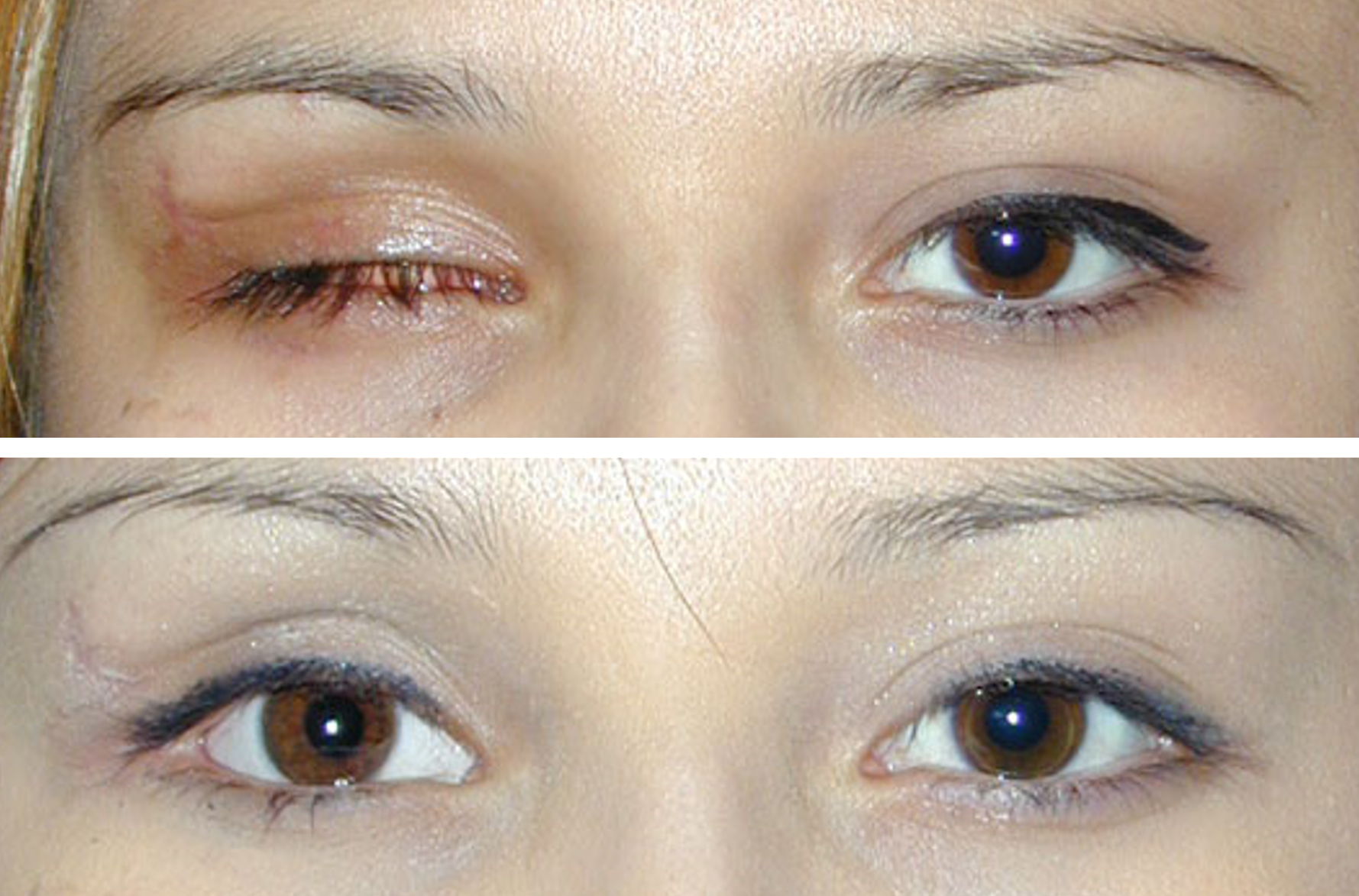 This is a before and after of a patient who got eyelid laceration repair done by Dr. Ron Pelton
