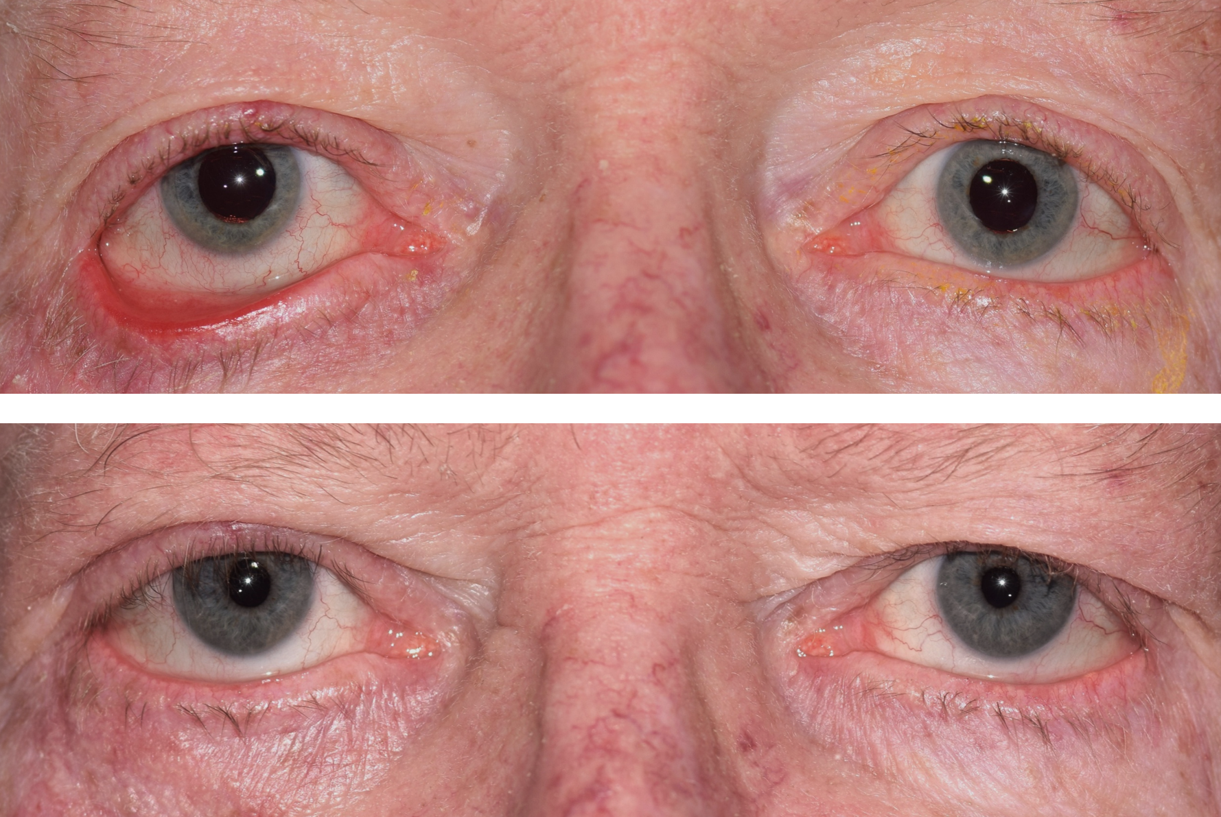 Pictured is a before and after of a patient who got right sided ectropion repair surgery done by Dr. Caroline Yu. In the before photo, his right lower eyelid is drooping downwards and outwards and red and irritated. The after photo correction