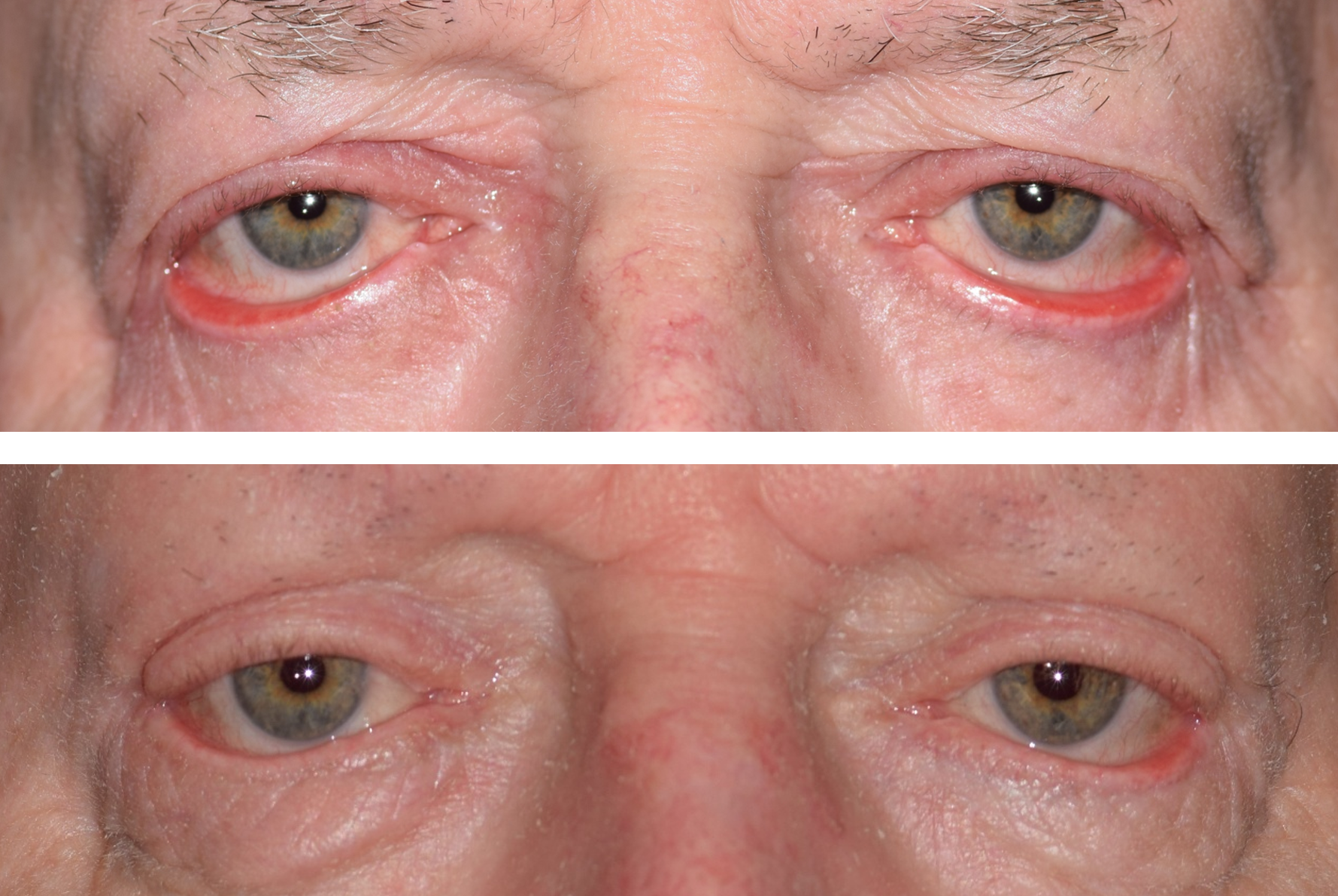 This is a before and after photo of a patient who got ectropion repair surgery performed by Dr. Ron Pelton. Ectropion is when the lower eyelids flip outwards causing irritation, dryness and redness.