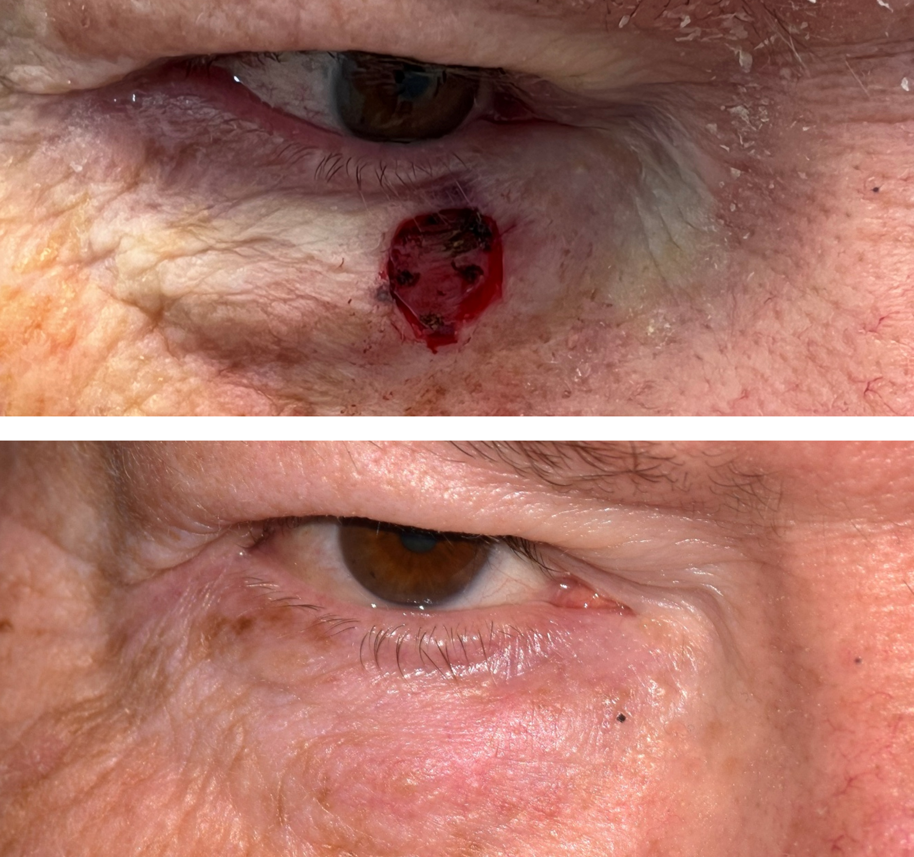 Pictured is a before and after photo of a man who got his skin cancer removed by getting a Mohs surgery done and the after photo shows the defect healed after Dr. Caroline Yu did the revision. Dr. Caroline Yu reconstructed the eyelid after his Mohs 