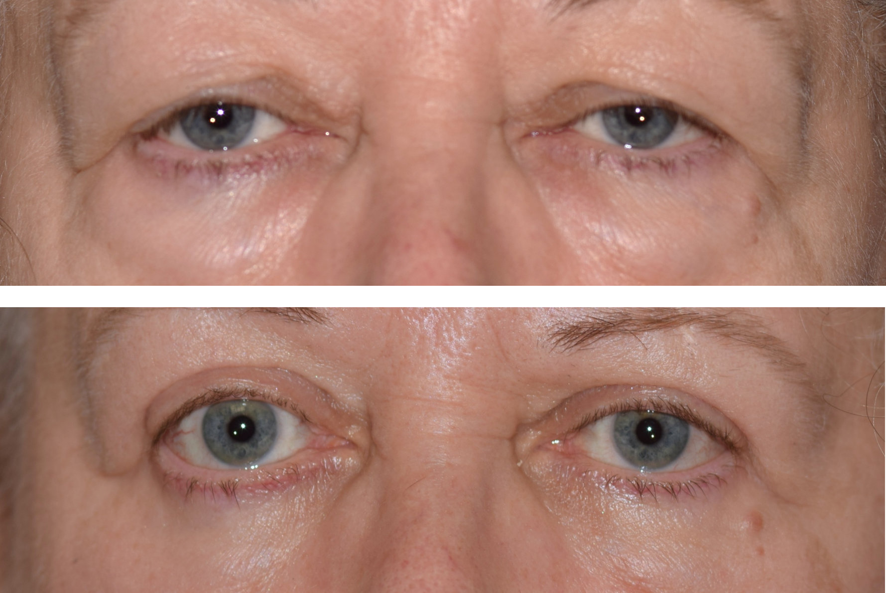 This is a before and after photo of an upper and lower blepharoplasty done by Dr. Caroline Yu. The after photo shows her eyelids lifted and her under eye bags gone