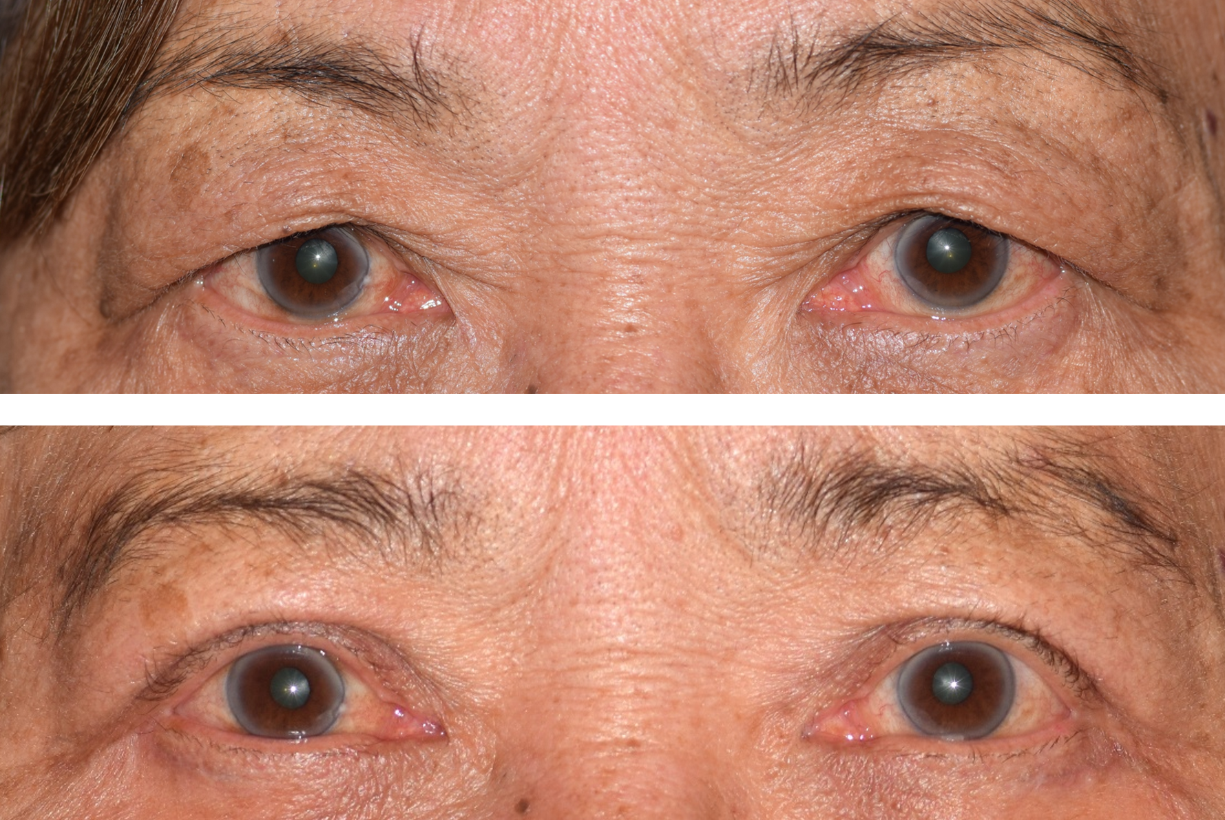 Pictured is a before and after photo after an upper eyelid lid, also called a blepharoplasty done by Dr. Ron Pelton. This surgery removes excess skin on the eyelids and improves vision