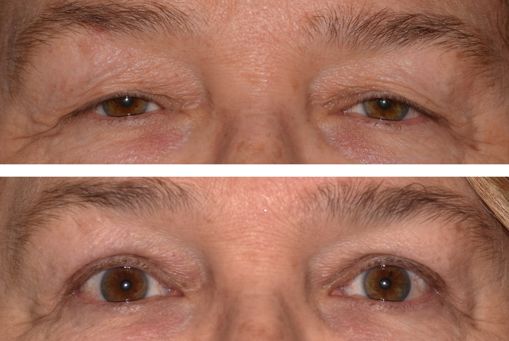 Before and after image of a young woman who got an upper eyelid blepharoplasty done by Dr. Caroline Yu