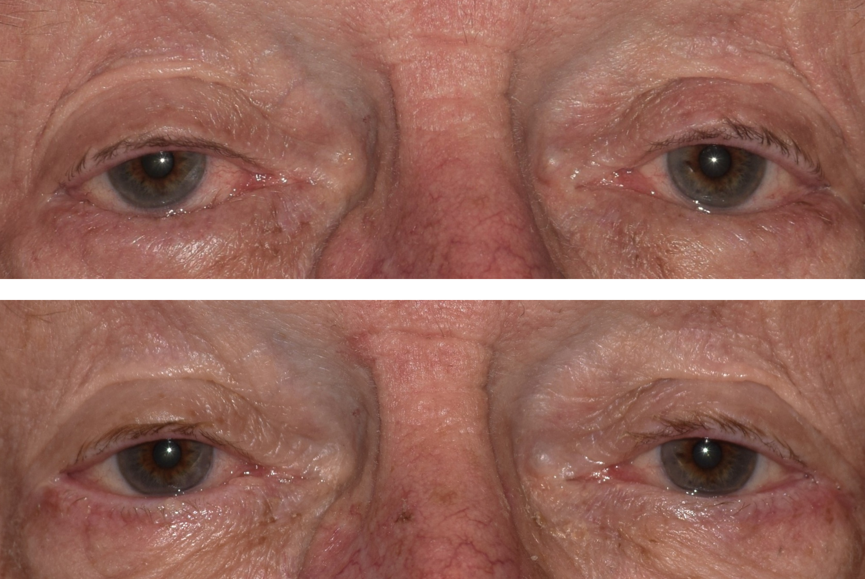 This is a before and after of a man who got entropion repair surgery by Dr. Caroline Yu. The before shows the eyelashes turning inwards and rubbing the patient's eyeballs. Afterwards, his eyelids are normal and there is no more irriation