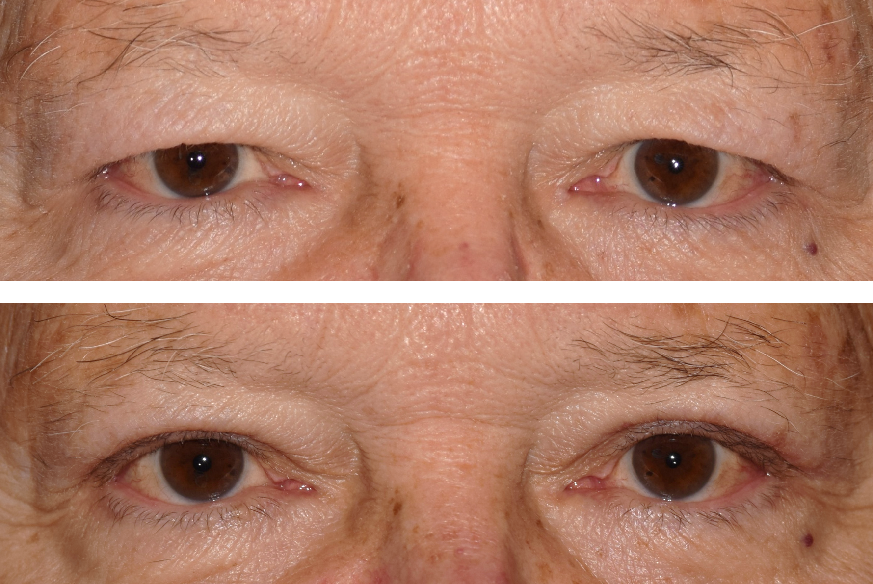 This image shows a man before his blepharoplasty with his eyelids hooded and after his blepharoplasty which makes his eyes look more awake and normal