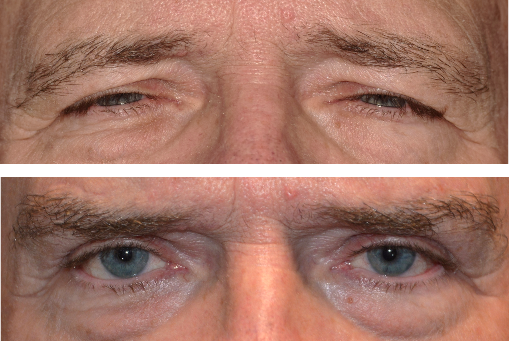 Pictured is a male's before and after results after an upper eyelid lift blepharoplasty and brow lift performed by Dr. Caroline Yu making his eyes more visible and not obstructing his view anymore