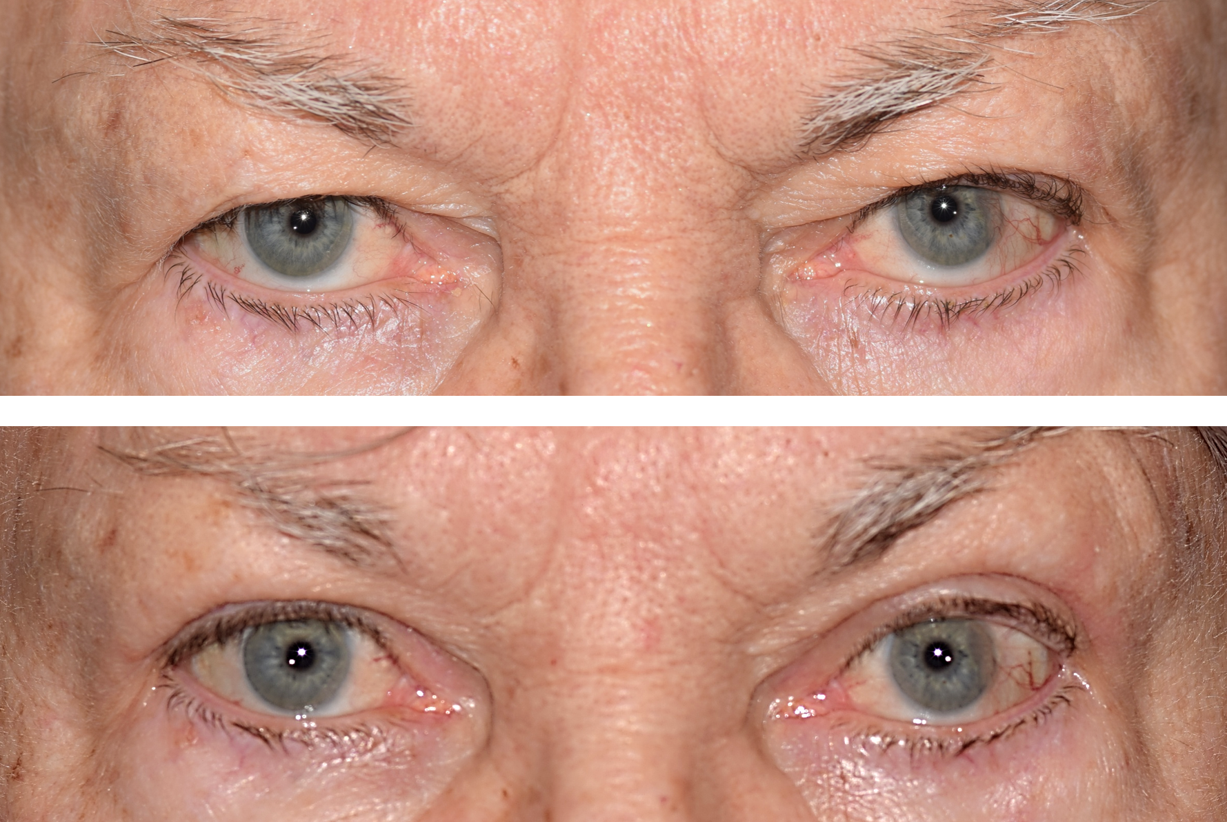 Pictured is a woman with her before and photos from her blepharoplasty surgery to correct her droopy eyelids aka dermatochalasis
