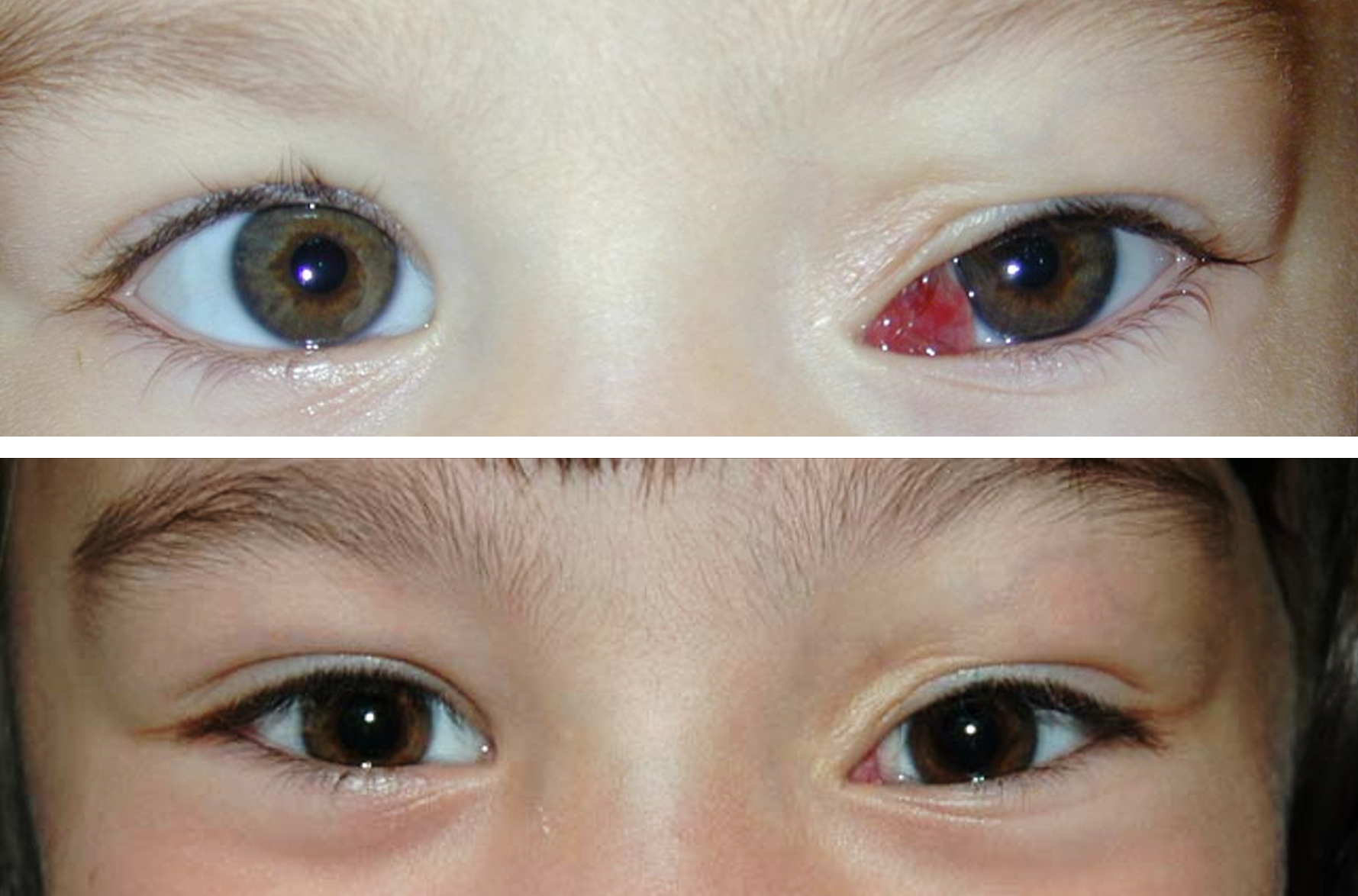This is a before and after photo of a child who got an orbital tumor removed by Dr. Ron Pelton
