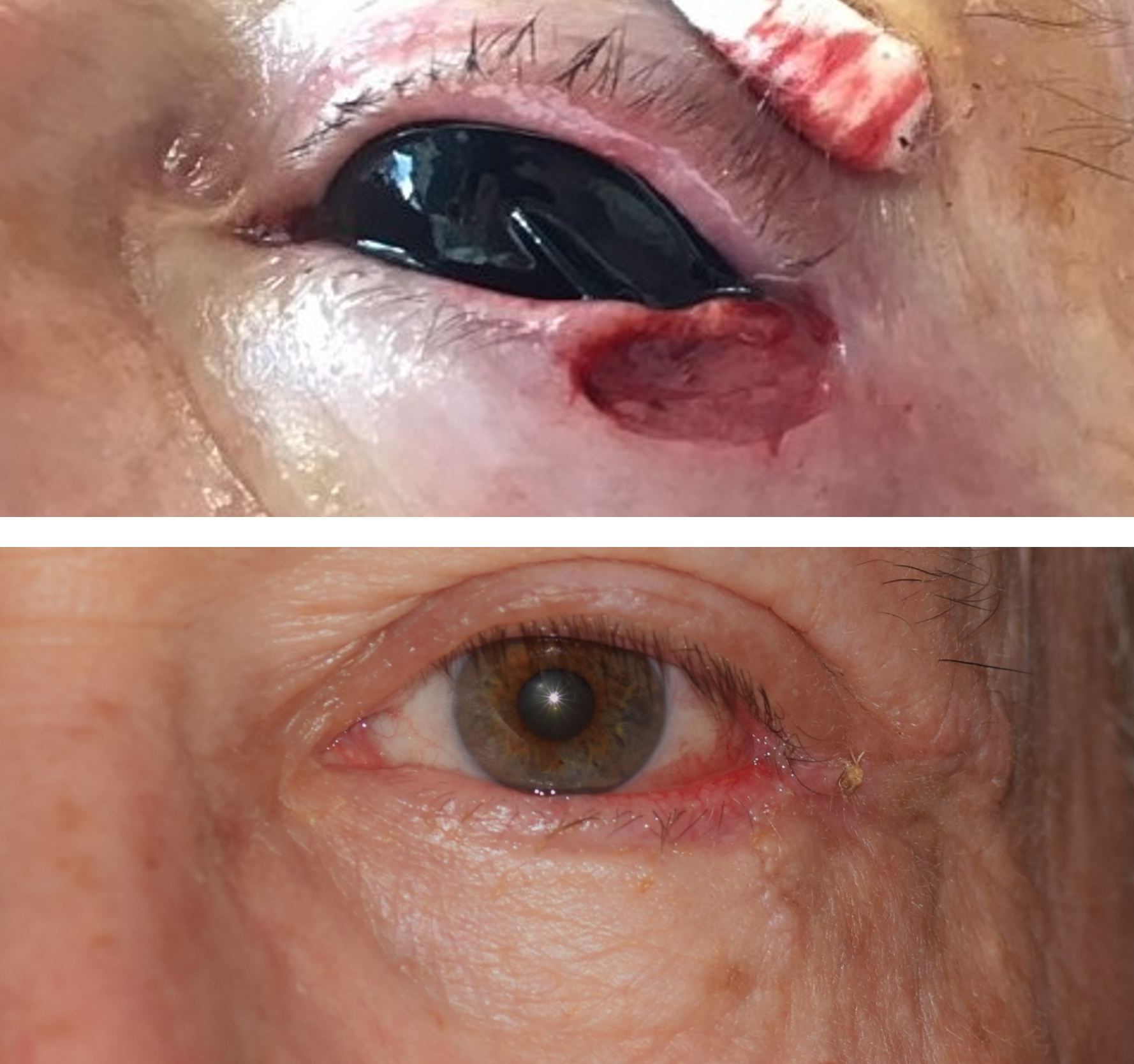 Pictured is a before and after photo of a man who got his skin cancer removed by getting a Mohs surgery done and the after photo shows the defect healed after Dr. Caroline Yu did the revision. Dr. Caroline Yu reconstructed the eyelid after his Mohs 
