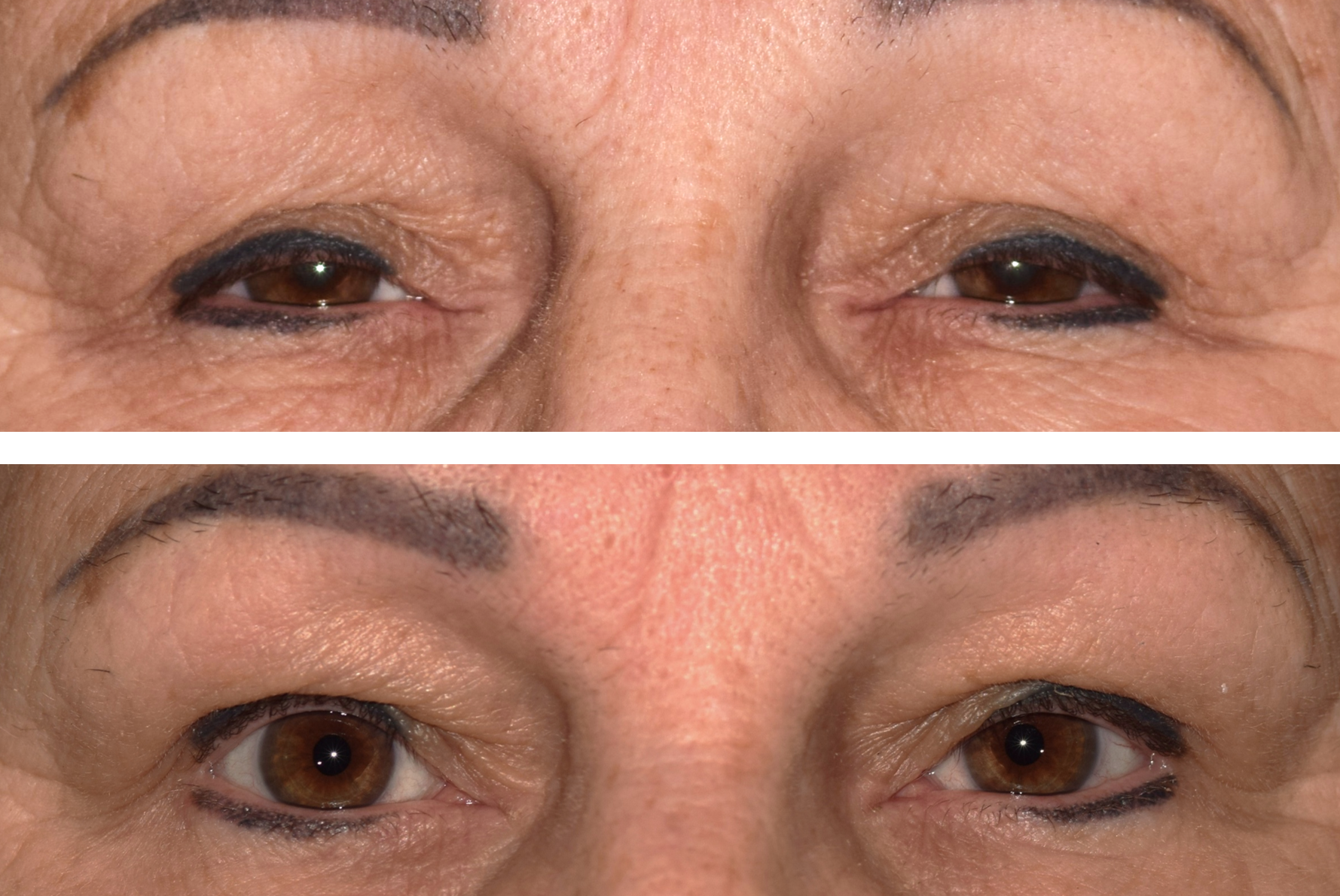 This image shows a woman before her ptosis eyelid surgery performed by Dr. Caroline Yu and the after with her eyes more open and alert and eyelids no longer drooping