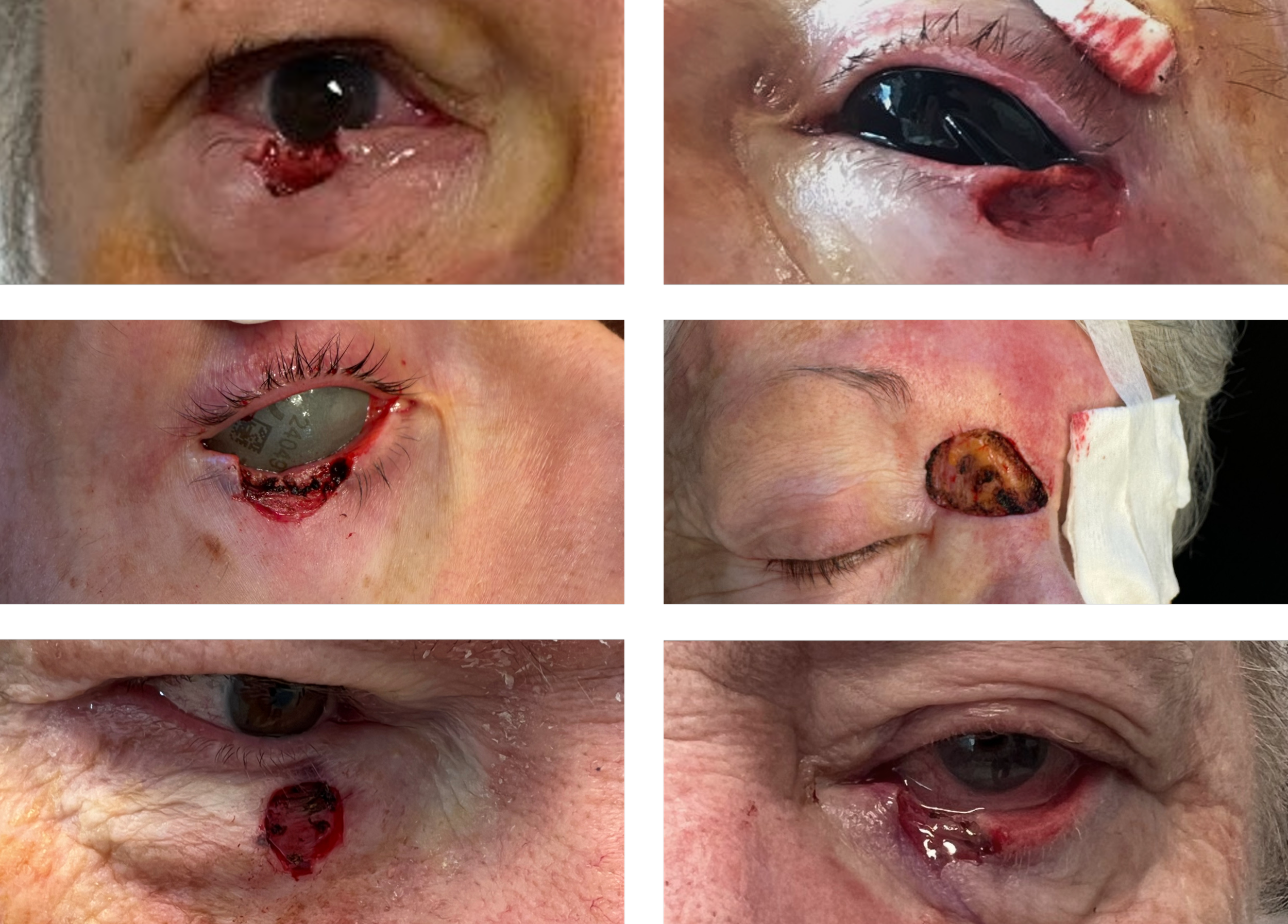 These are photos of patients after their Mohs surgeries with their dermatologists before they come to our office for repair