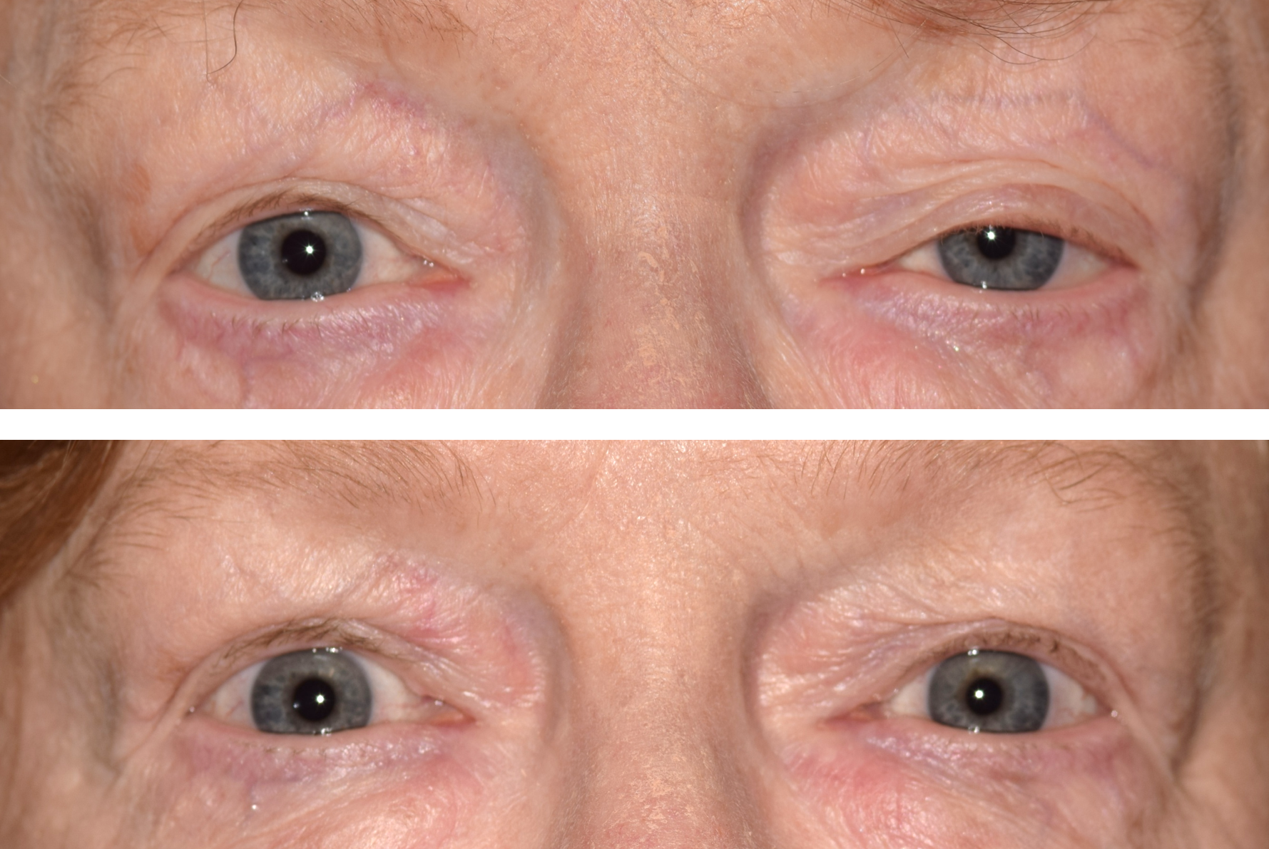 This image shows a woman before her ptosis surgery where her eyelid is drooping and then the after photo and her eyelids are even and more alert