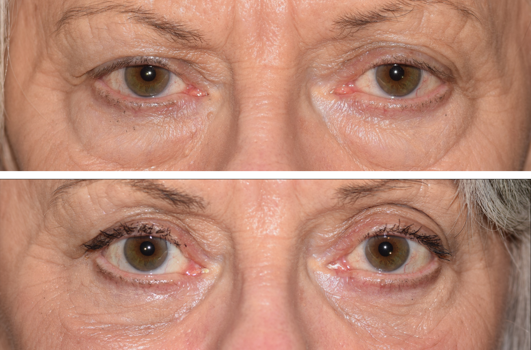 This is a before and after photo of an upper and lower blepharoplasty done by Dr. Ron Pelton. The after photo shows her eyelids lifted and her under eye bags gone