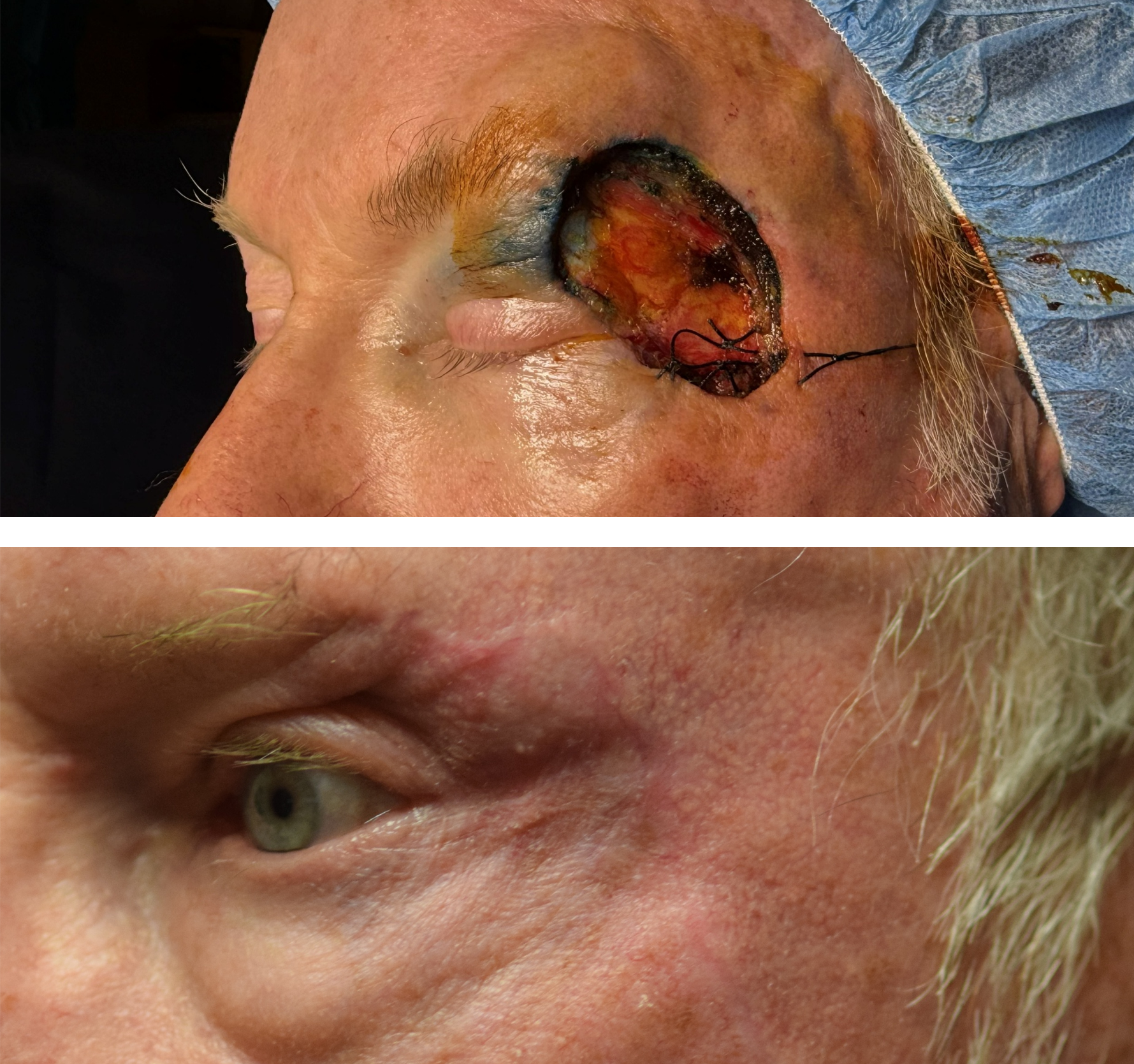 Pictured is a before & after photo of a man who got his skin cancer removed by getting a Mohs surgery done and the after photo shows the defect healed after Dr. Ron Pelton did the revision. Dr. Ron Pelton reconstructed the eye area after his Mohs 