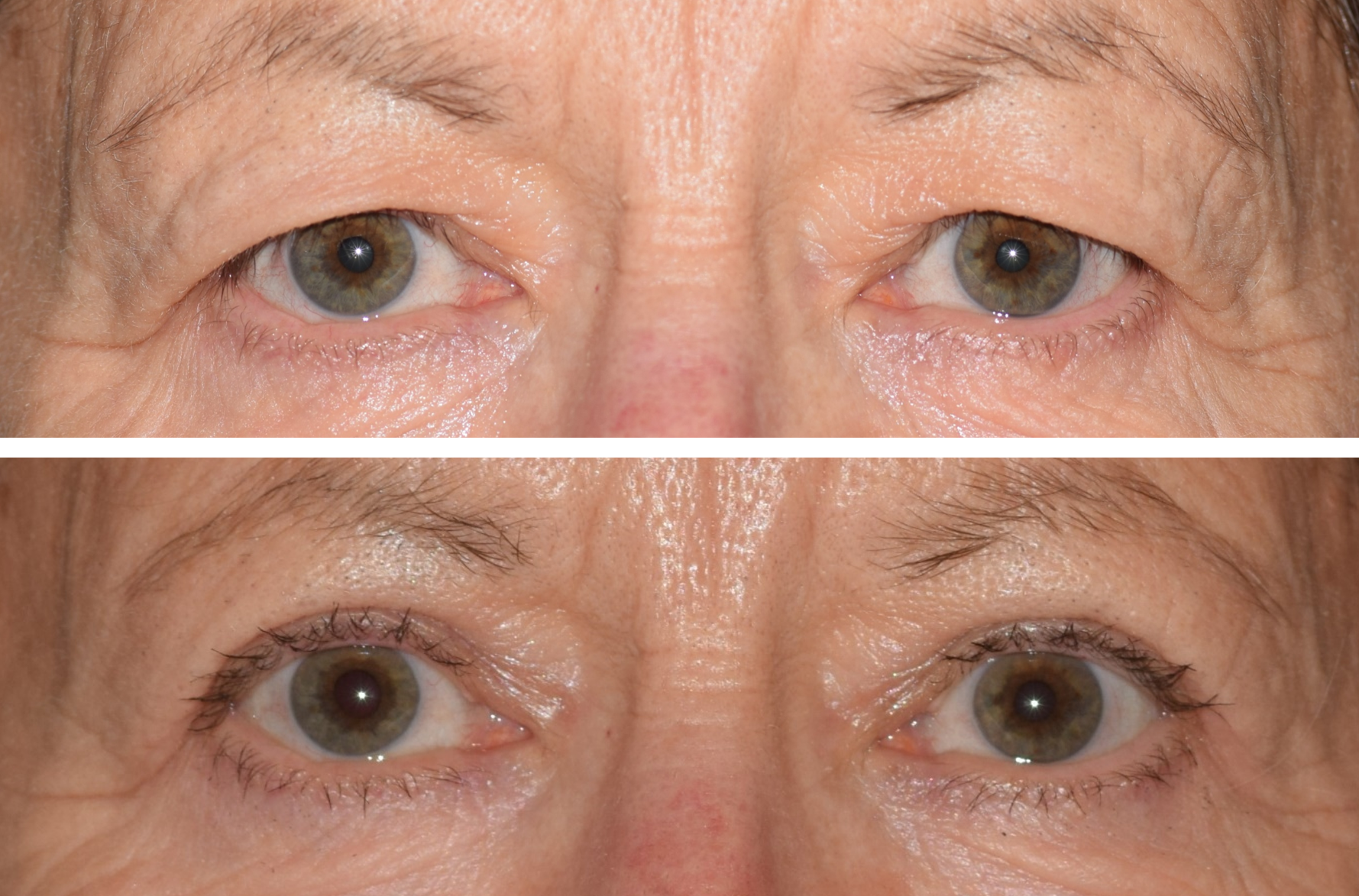 Pictured is a before and after photo after an upper eyelid lid, also called a blepharoplasty done by Dr. Ron Pelton. This surgery removes excess skin on the eyelids and improves vision