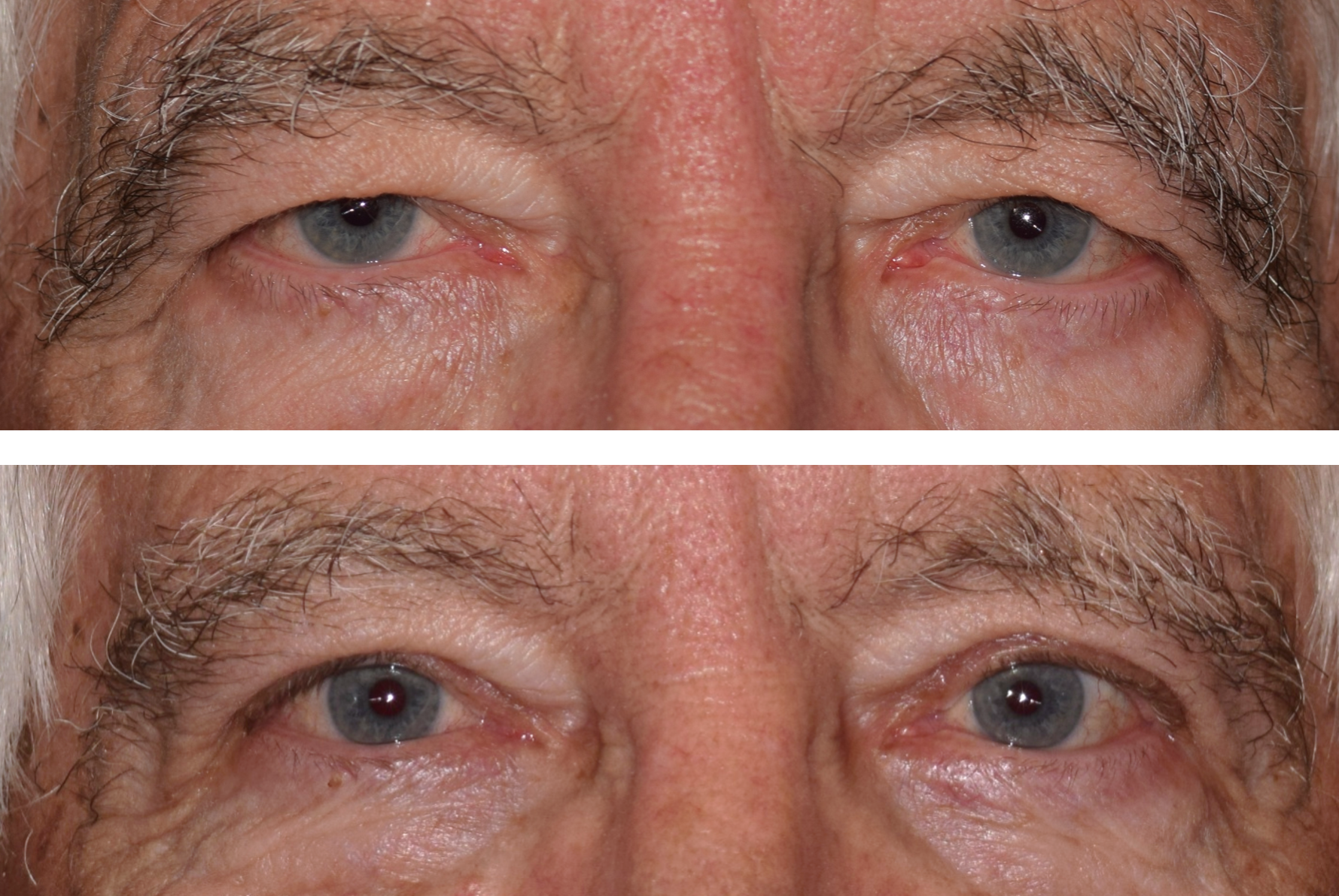 An older gentleman showing a before and after of his blepharoplasty and eyebrow ptosis surgery.