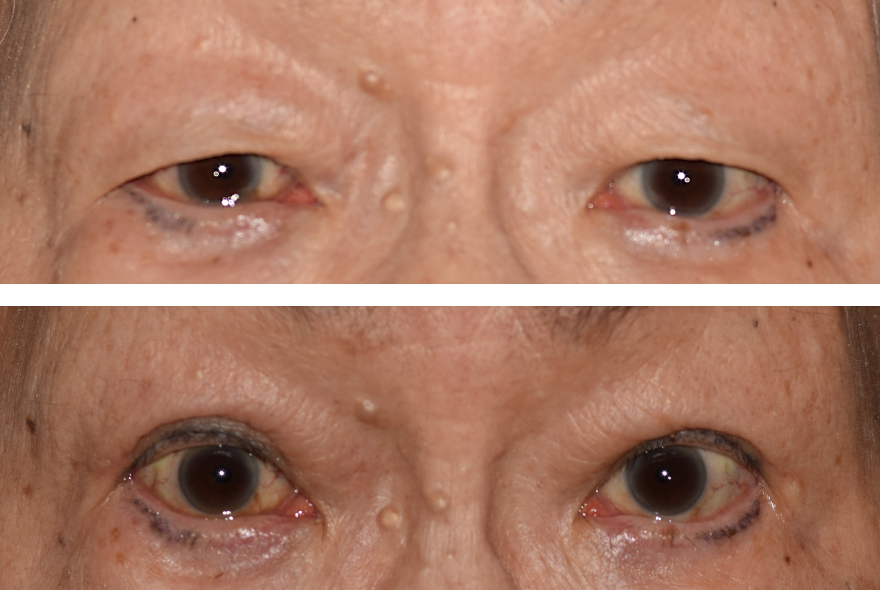 This image shows an older Asian women's before and after photo of her upper eyelid blepharoplasty showing significant decrease in excess skin and opening her eyes up more to see better