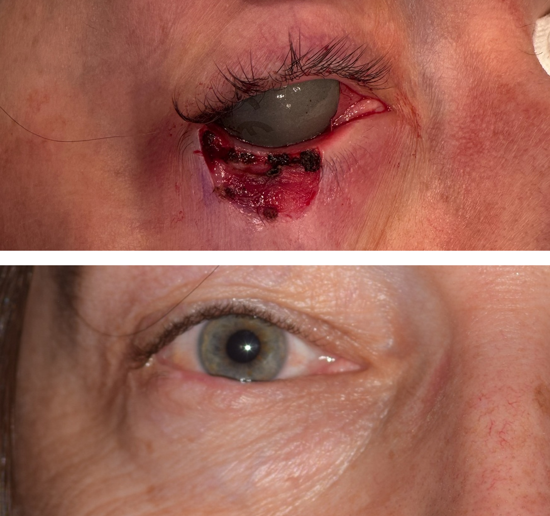 Pictured is a before & after photo of a woman who got her skin cancer removed by getting a Mohs surgery done and the after photo shows the defect healed after Dr. Ron Pelton did the revision. Dr. Ron Pelton reconstructed the eyelid after her Mohs 