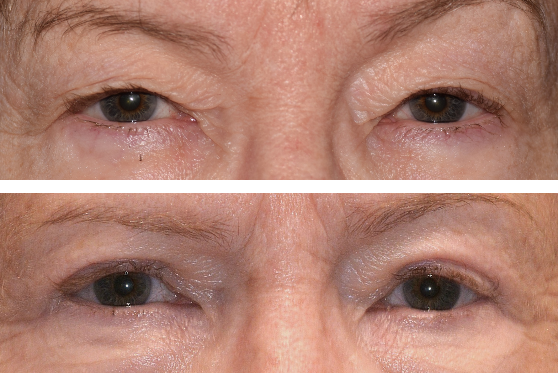 Pictured is a before and after photo of a woman after getting her eyelid lift upper blepharoplasty performed by Dr. Caroline Yu. After her eyelid lift- she looks more alert and her visual field is not obstructed by excess skin