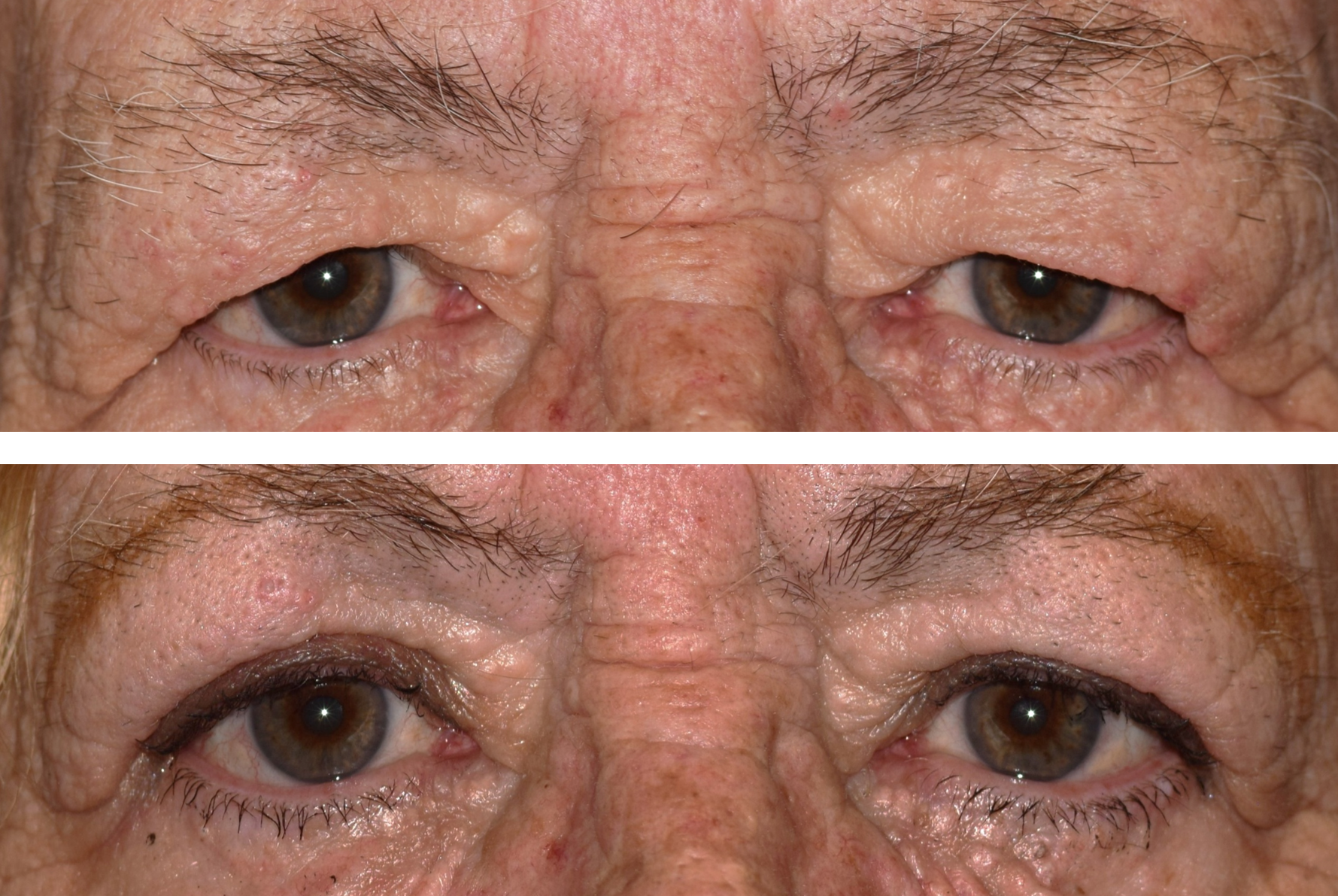 Pictured is a before and after photo of a woman after getting her eyelid lift upper blepharoplasty performed by Dr. Caroline Yu. After her eyelid lift- she looks more alert and her visual field is not obstructed by excess skin