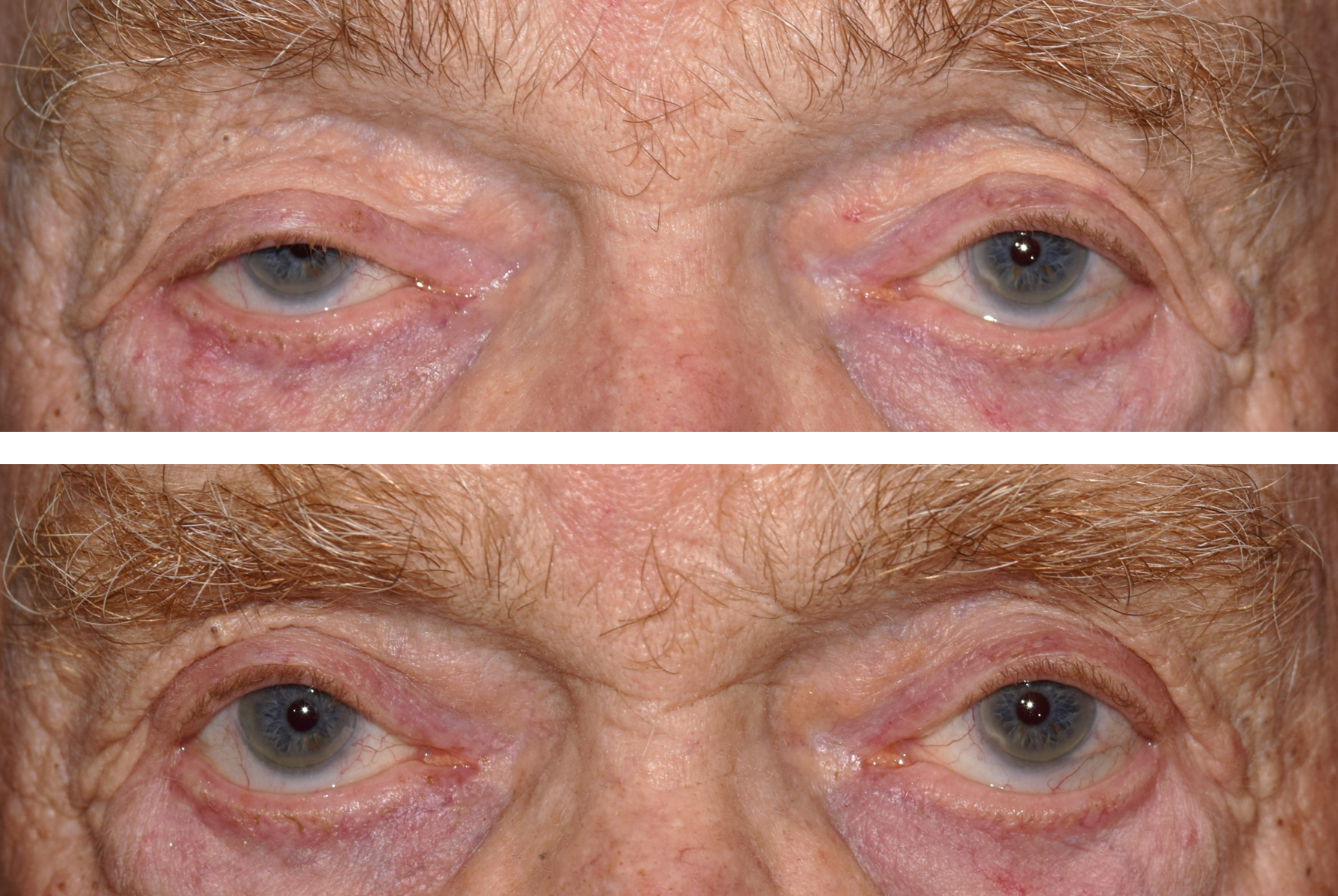 pictured is an older man with before and after examples from his ptosis surgery performed by Dr. Caroline Yu. His eye appear more open and can see better