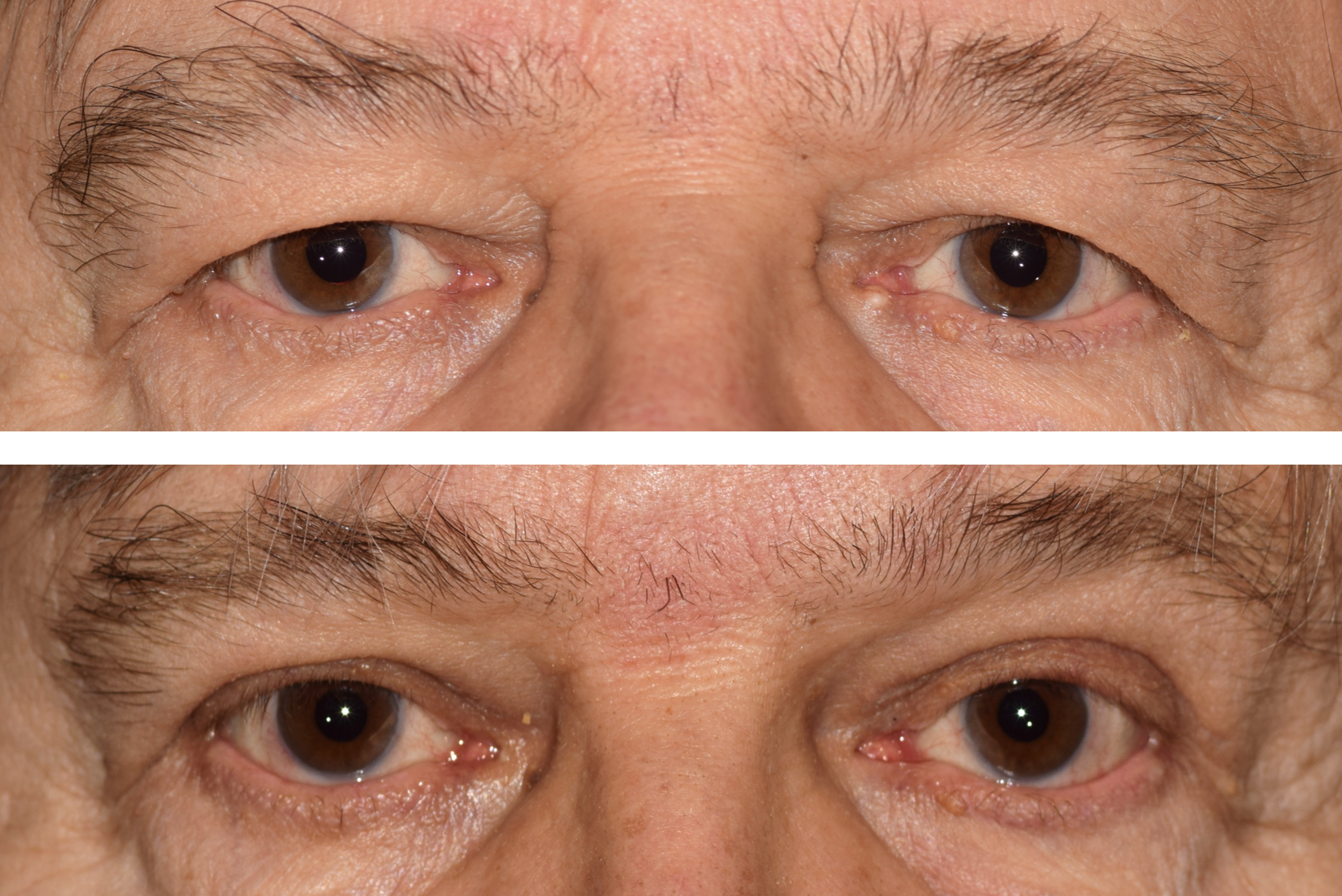 Pictured is a male with before and after photos after getting an upper eyelid blepharoplasty. The after photo shows him more awake and vision has improved.
