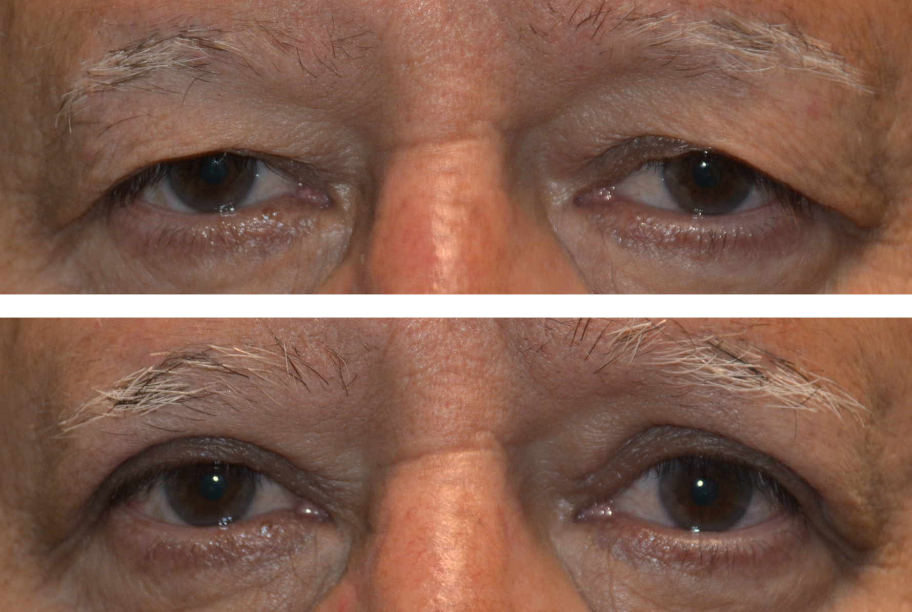 This is a before and after photo of an older man to show the results of his upper eyelid blepharoplasty and ptosis repair surgery performed by Dr. Caroline Yu. In the after photo, his eyes are more open and awake and vision has improved