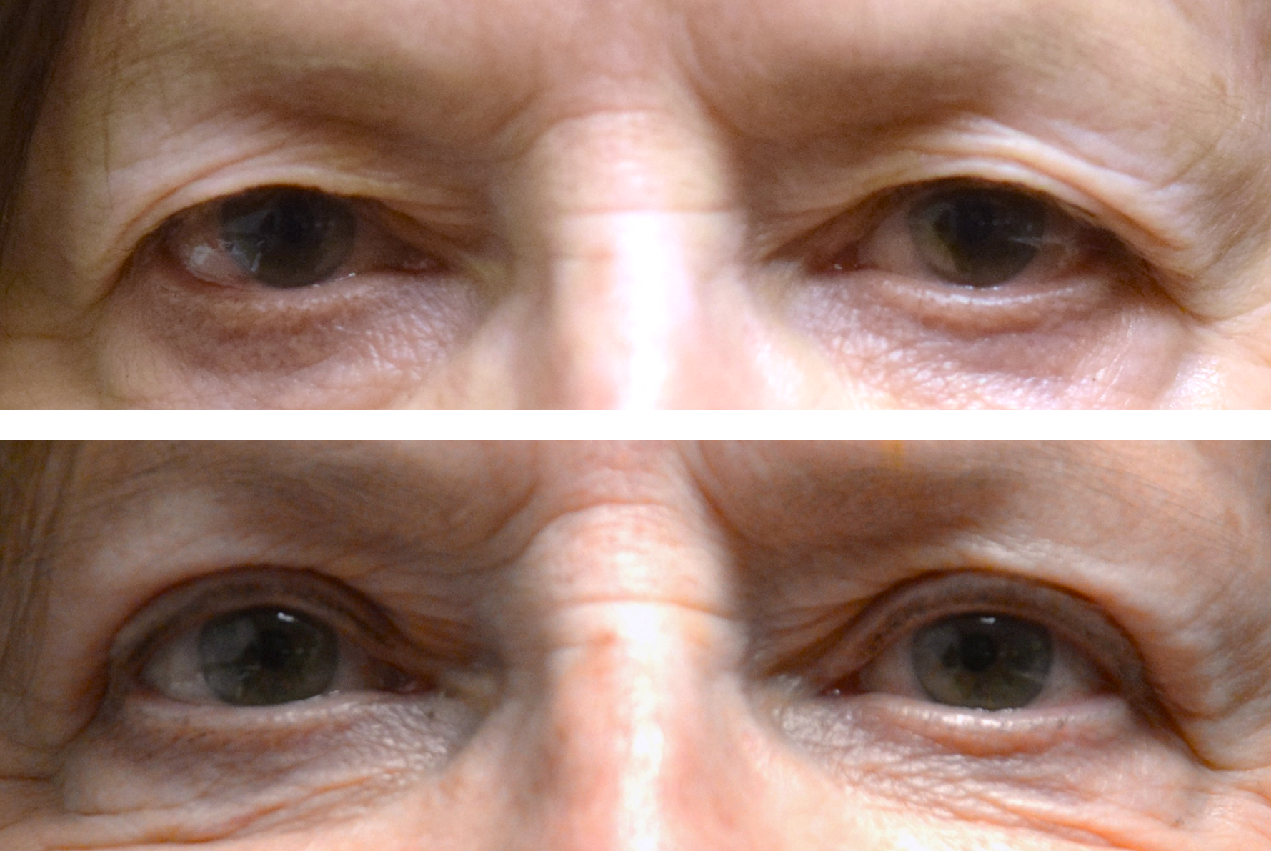 Before and after results of an upper eyelid blepharoplasty performed by Dr. Caroline Yu