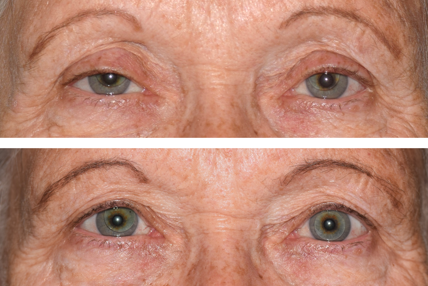 This is a before and after photo of a patient that got ptosis surgery performed by Dr. Ron Pelton. Ptosis repair lifts the eyelid improving vision and appearance