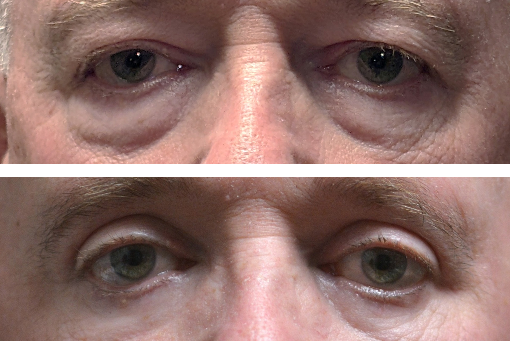 This is a before and after of an upper eyelid blepharoplasty and lower eye bag blepharoplasty done by Dr. Ron Pelton. Visual field is improved and under eye bags are removed
