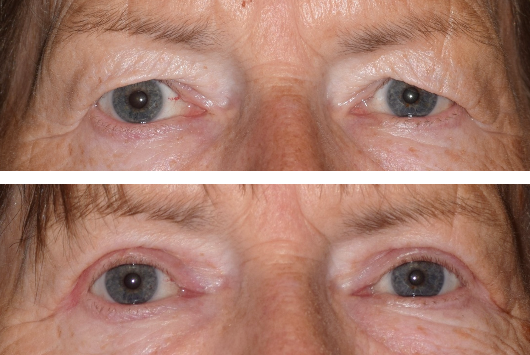 Pictured is a before and after photo after an upper eyelid lid, also called a blepharoplasty done by Dr. Ron Pelton. This surgery removes excess skin on the eyelids and improves vision