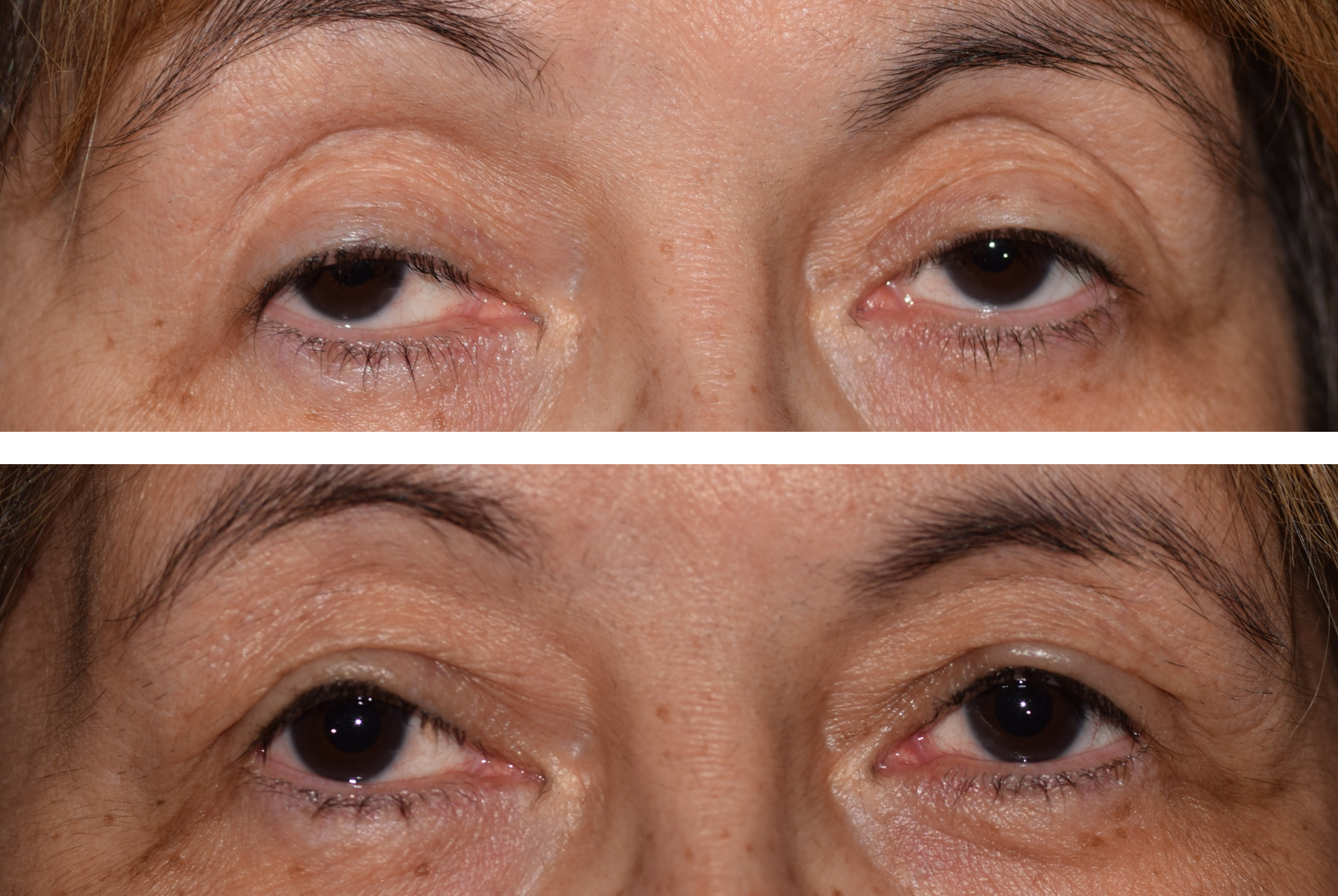 Before and after image from ptosis drooping eyelid surgery, patient looks more aware and awake and can see better 