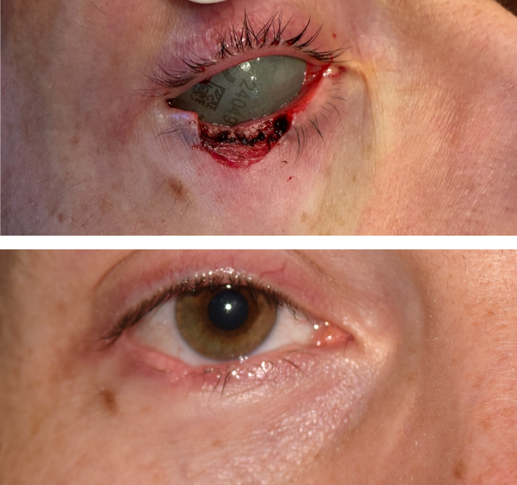 Pictured is a before & after photo of a man who got his skin cancer removed by getting a Mohs surgery done and the after photo shows the defect healed after Dr. Ron Pelton did the revision. Dr. Ron Pelton reconstructed the eyelid after his Mohs 