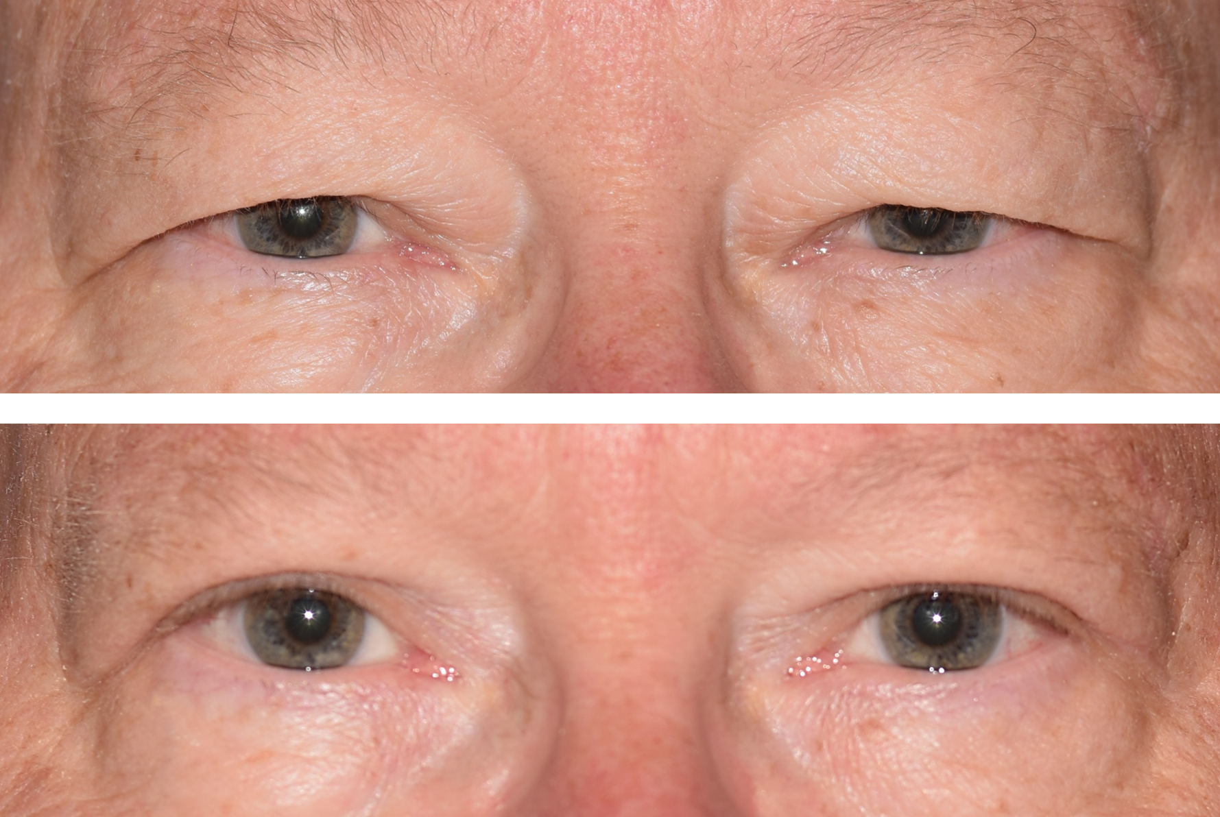 Pictured is a before and after photo after an upper eyelid lid, also called a blepharoplasty done by Dr. Ron Pelton. This surgery removes excess skin on the eyelids and improves vision