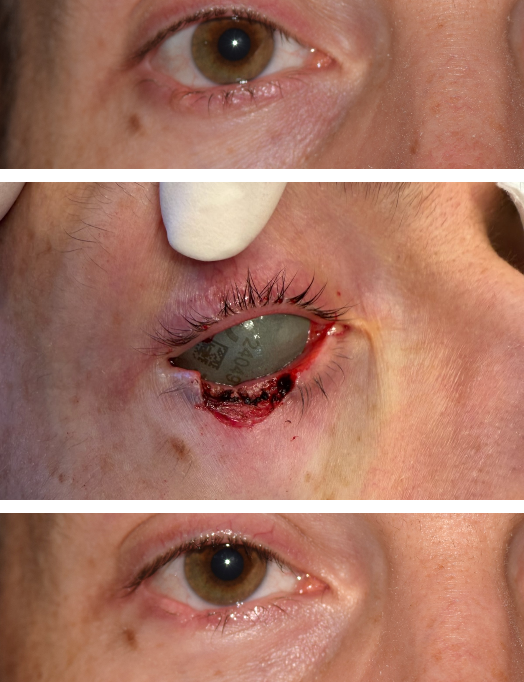 This is a before, during, and after of a man who was diagnosed with skin cancer, got a Mohs surgery and then the after photo shows healing after Dr. Ron Pelton repaired the Mohs defect.