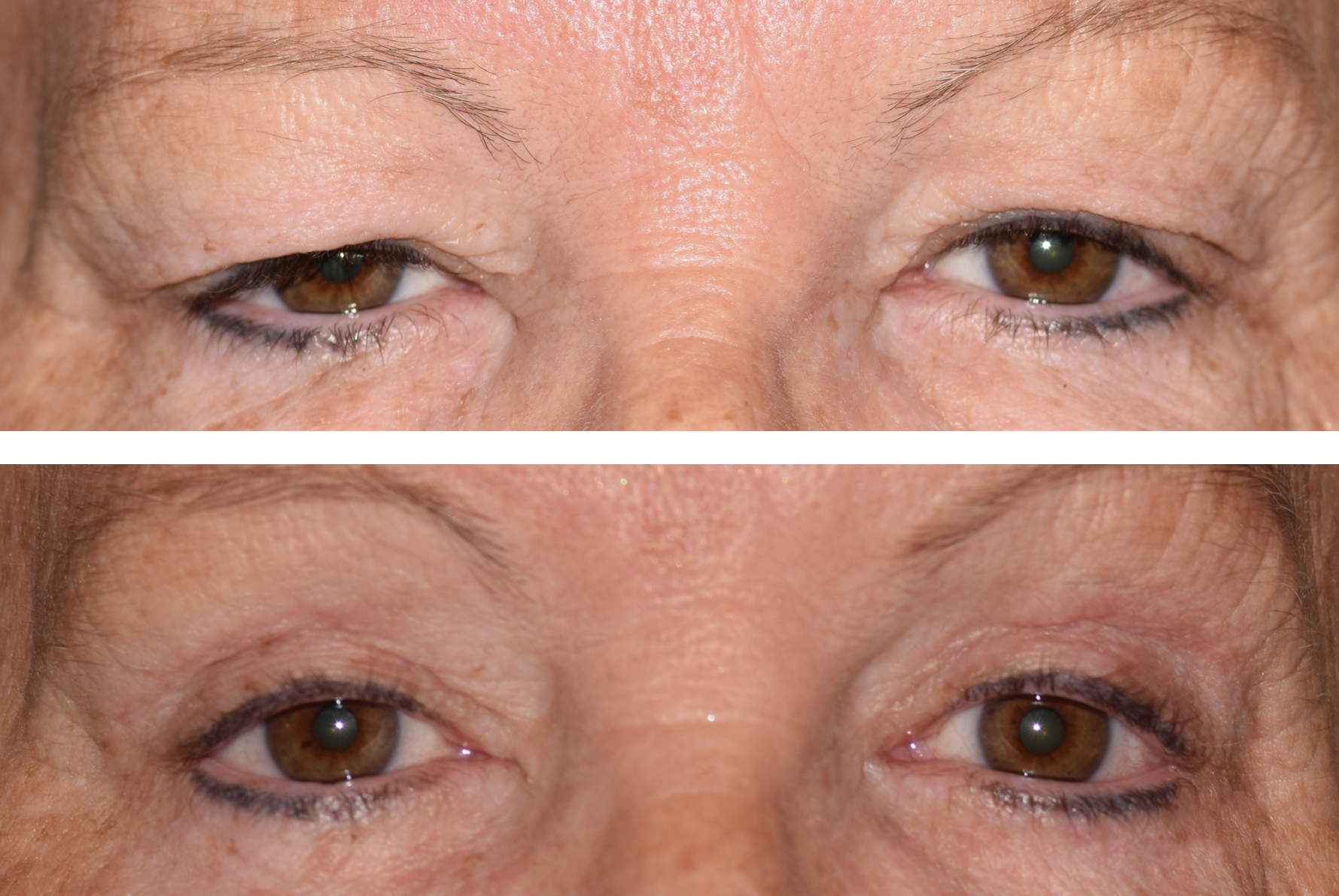 It is a before and after photo of an upper eyelid blepharoplasty on a 66 year old women showing significant decrease in excess skin on her eyelids.