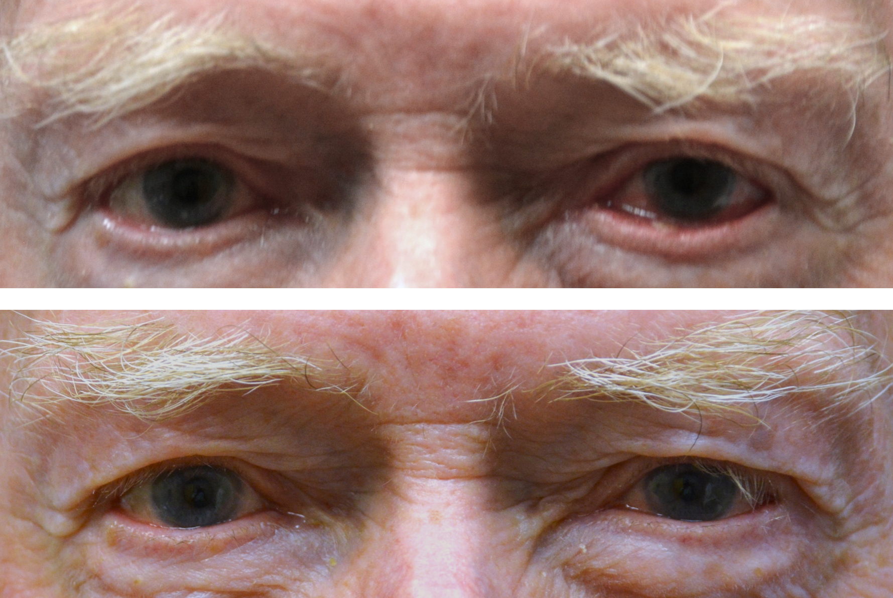 Before and after of a photo of a man who got ectropion repair of his lower lids performed by Dr. Caroline Yu. This is the lids flipping outward and causing redness, tearing and irritation