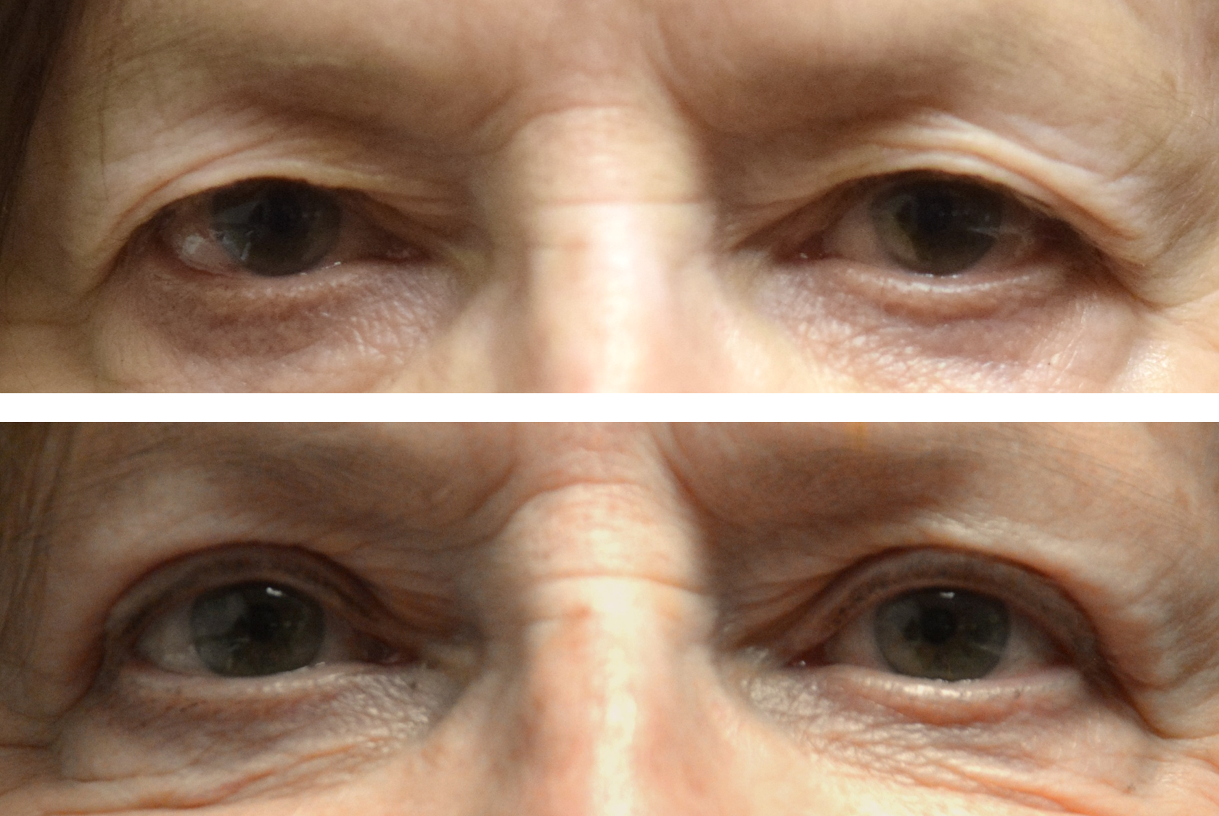 Before and after results of an upper eyelid blepharoplasty