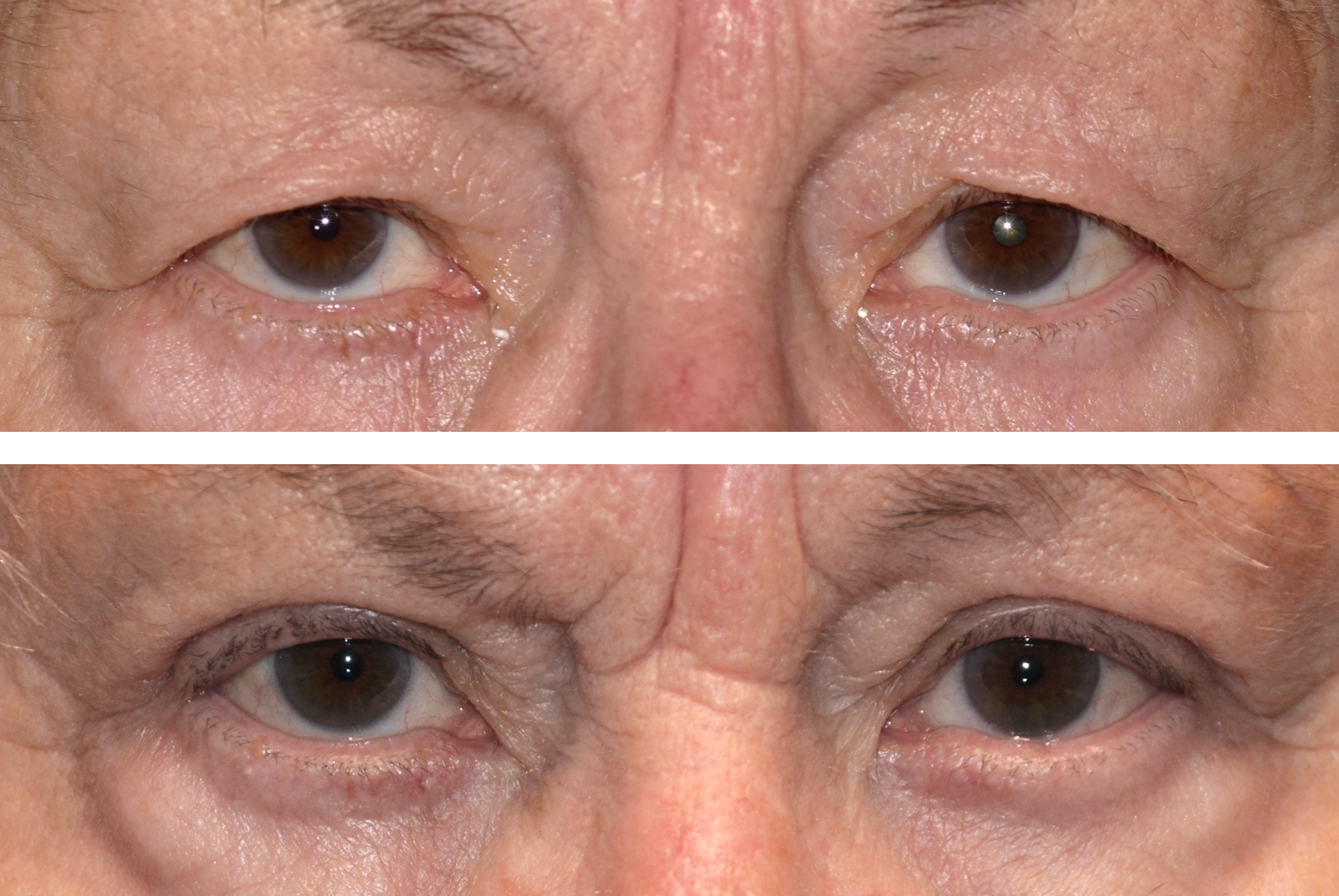 Pictured is a before and after photo of a woman after getting her eyelid lift upper blepharoplasty performed by Dr. Caroline Yu. After her eyelid lift- she looks more alert and her visual field is not obstructed by excess skin