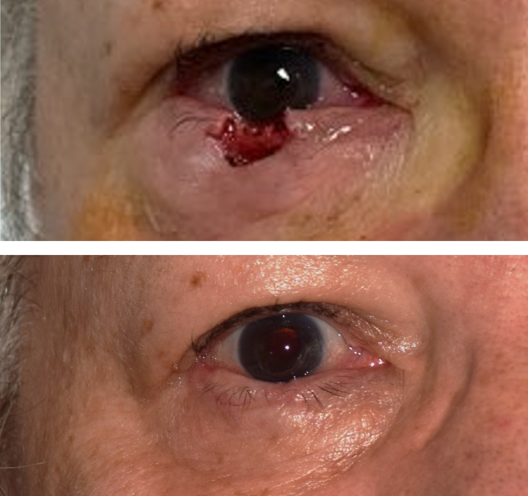 Pictured is a before & after photo of a woman who got her skin cancer removed by getting a Mohs surgery done and the after photo shows the defect healed after Dr. Caroline Yu did the revision. Dr. Caroline Yu reconstructed the eyelid after her Mohs 